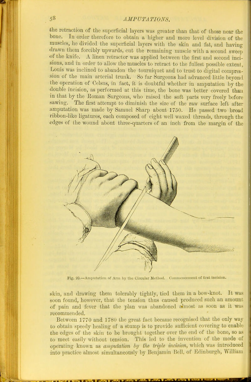the retraction of the superficial layers was greater than that of those near the bone. In order therefore to obtain a higlier and more level division of the muscles, he divided the superficial layers witli the skin and fat, and having ^kawn them forcibly upwards, cut tlie remaining muscle with a second sweeji of the knife. A linen retractor was applied between the first and second inci- sions, and in order to aUow the muscles to retract to the fullest possible extent, Louis was inclined to abandon the tourniquet and to trust to digital compres- sion of the main arterial trunk. So far Surgeons had advanced little beyond the operation of Celsus, in fact, it is doulifcful whether in amputation by the double incision, as performed at this time, the bone was better covered than in that by the Eoman Surgeons, who raised the soft parts very freely Ijefore sawing. The first attempt to diminish the size of the raw surface left after amputation was made by Samuel Sharp about 1750. He passed two broad ribbon-like ligatures, each composed of eight well waxed threads, through the edges of the wound about three-quarters of an inch fi-om the margin of the Fig. 20.—Aiiiiiiitfttioii of Ann by the Circular lletliud. Coiuiiieiiceiiient of flrst incision. fikin, and drawiug them tolerably tightly, tied them in a bow-knot. It was soon found, however, that the tension thus caused pi-oduced such an amount of pain and fever that the plan was abandoned almost as soon as it was recommended. Between 1770 and 1780 the great fact became recognised that the only way to obtain speedy healing of a stump is to provide sufficient covering to enable the edges of the skin to be brought together over the end of the bone, so as to meet easily without tension. This led to the invention of the mode of operating known as amputatmi hij the iriple incision, which was introduced into practice almost simultaneously by Benjamin Bell, of Edinburgh, William