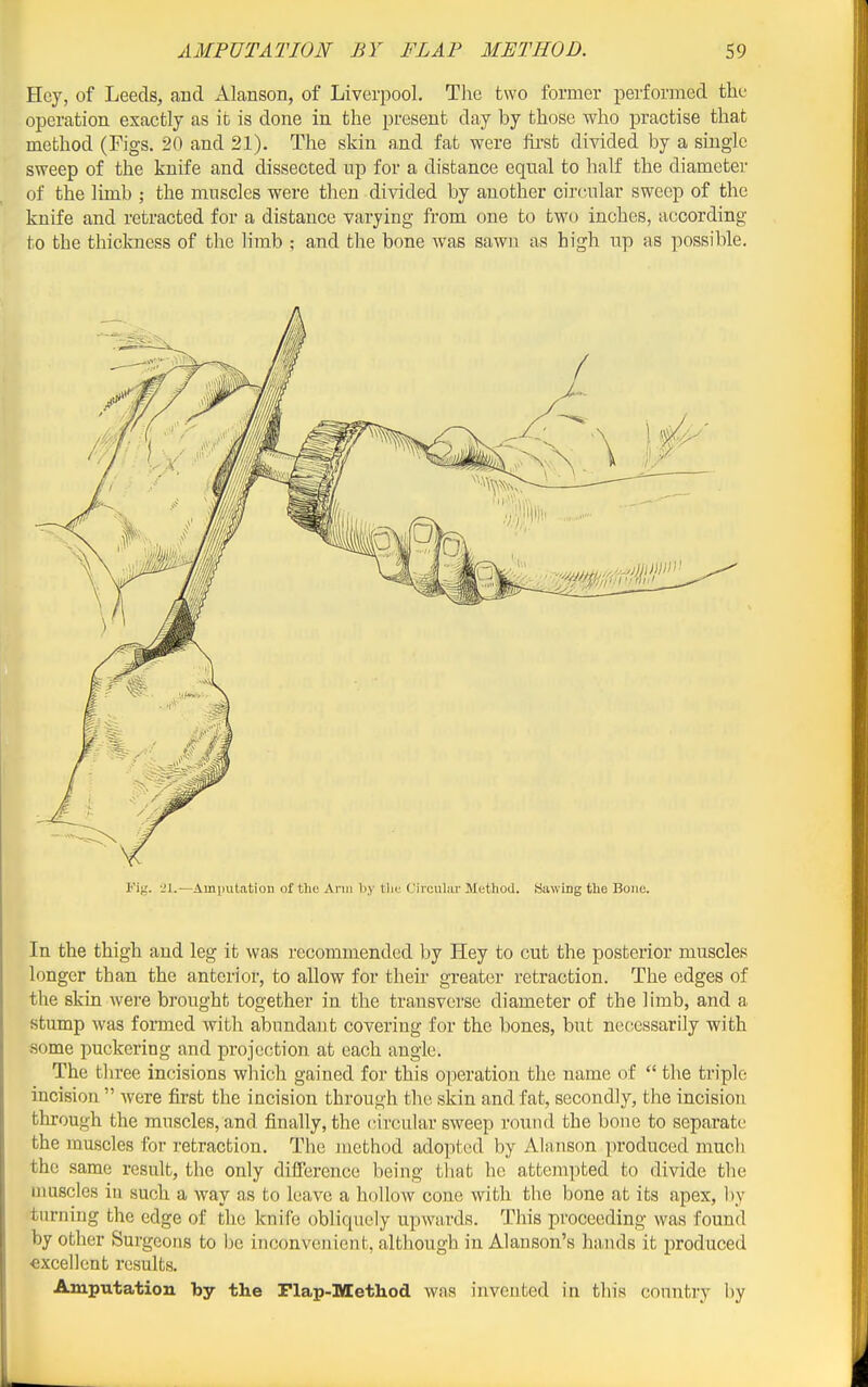 Hey, of Leeds, and ALanson, of Liverpool. The two former performed the operation exactly as it is done in the present day by those who jDractise that method (Figs. 20 and 21). The skin and fat were first divided by a single sweep of the knife and dissected up for a distance equal to half the diameter of the limb ; the muscles were then divided by another circular sweep of the knife and retracted for a distance varying from one to two inches, according to the thickness of the limb ; and the bone was sawn as high up as possible. i''ig. -Jl.—Amimtation of the Ann Viy tlic Circular Method. Sawing the Bone. In the thigh and leg it was recommended l)y Hey to cut the posterior muscles longer than the anterior, to allow for their greater retraction. The edges of the skin were brought together in the transverse diameter of the limb, and a stump was foraied with abundant covering for the bones, but necessarily with some puckering and projection at each angle. The three incisions which gained for this operation the name of  the triple incision  Avere first the incision through the skin and fat, secondly, the incision through the muscles, and finally, the (nrcular sweep round the bone to separate the muscles for retraction. The method adopted by Alanson produced mucli the same result, the only difl'erence being that he attempted to divide tlie muscles in such a way as to leave a hollow cone with the bone at its apex, by turning the edge of the knife obliquely upwards. This proceeding was found by other Surgeons to be inconvenient, although in Alanson's hands it produced excellent results. Amputation by the Flap-Method was invented in this country by