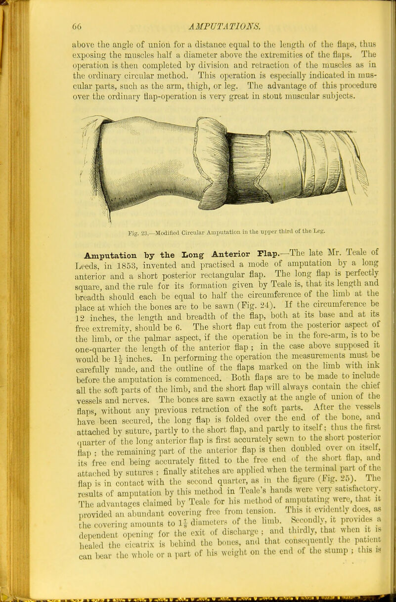 abo^'c the angle of union for a distance equal to the length of the flaps, thus exposing the muscles half a diameter above the extremities of the flaps. The operation is then completed by division and retraction of the muscles as in the ordinary circular method. This operation is especially indicat<id in mus- cular parts, such as the arm, thigh, or leg. The advantage of this procedure over the ordinary flap-operation is very great in stout muscular suljjects. Fig. 23.—Modiflod Circular Amputation in the upper tliird of the Leg. Amputation by the Long Anterior Plap.—The late Mr. Teale of Leeds, in 1853, invented and practised a mode of amputation by a long anterior and a short posterior rectangular flap. The long flap is perfectly square, and the rule for its formation given by Teale is, that its length and breadth should each be equal to half the circumference of the limb at the place at which the bones are to be sawn (Fig. 24). If the circumference be 12 inches the length and breadth of the flap, both at its base and at its fi-ee extremity, should be 6. The short flap cut from the posterior aspect of the limb, or the palmar aspect, if the operation be m the fore-ann, is to be one-quarter the length of the anterior flap ; in the case above supposed it would be 1^ inches. In performing the operation the measurements must be carefully made, and the outhne of the flaps marked on the limb with mk before the amputation is commenced. Both flaps are to be made to mclude all the soft parts of the limb, and the short flap will always contain the chief vessels and nerves. The bones are sawn exactly at the angle of umon of the flaps without any previous retraction of the soft parts. After the vessels have been secured, the long flap is folded over the end of the bone, and attached by suture, partly to the short flap, and partly to itself; thus the hrst (luarter of the long anterior flap is first accurately sewn to the short posterior flap • the remaining part of the anterior flap is then doubled over on itself its free end being accurately fitted to the free end of the short flap, and attached by sutures ; finally stitches are applied when the terminal part of the flap is in contact with the second quarter, as in the figure (Fig. 25) The results of amputation by this method in Tealc's hands were very sat.sfactoiy T^he advantages claimed by Teale for his method of amputating were, that it provided an abundant covering fi-ee from tension. This it evidently does, as he covering amounts to 1| diameters of the limb Socodb^ i provides a dependent opening for the exit of discharge ; and thu-dly, that when t , healed the cicatrix is behind the bones, and that consequently the patient can bear the whole or a part of his weight on the end of the stump ; this is i