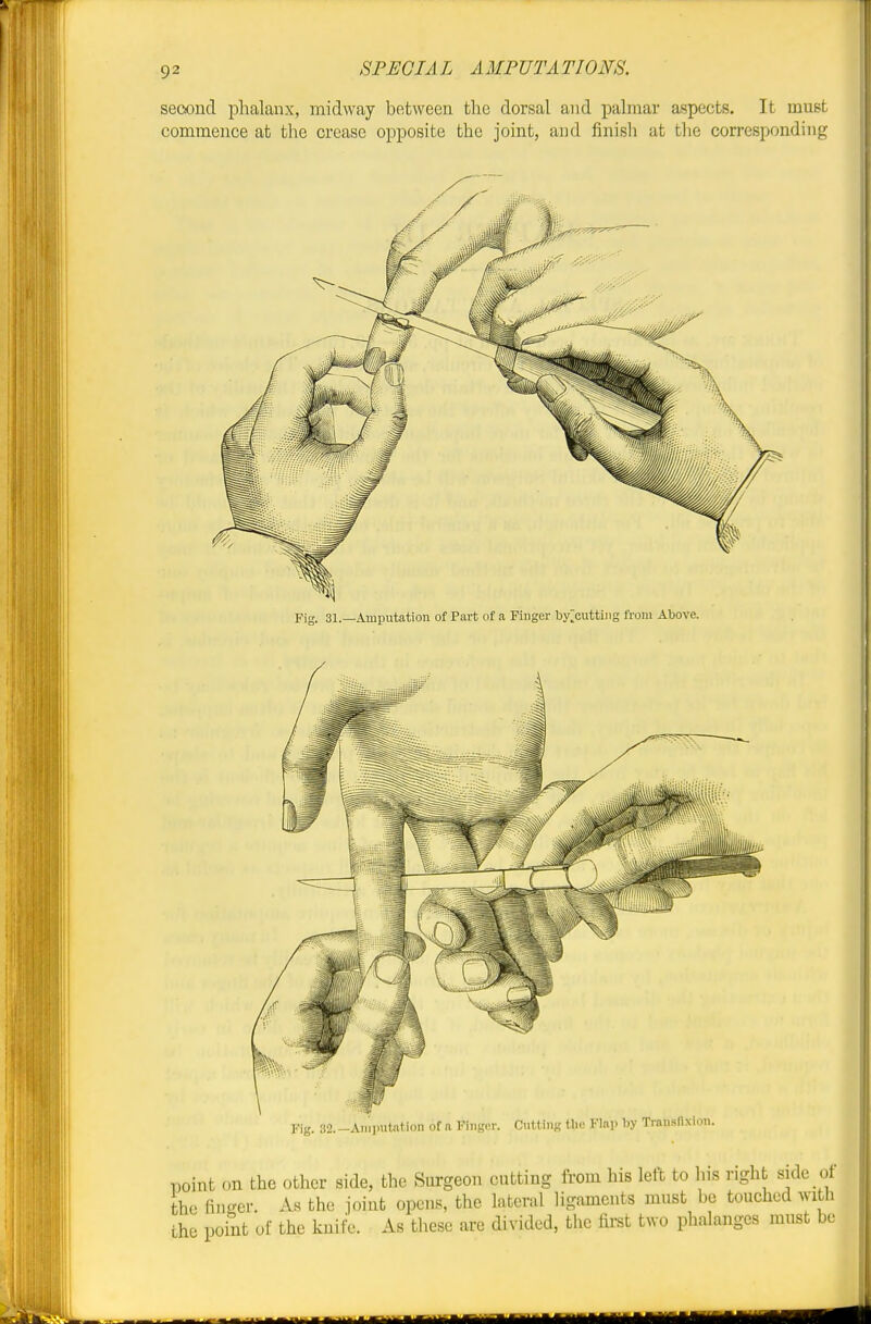 Fig. 31.—Amputation of Part of a Fiuger by^cutting froin Above. Fig. 32. -Amputation of a Finger. Cutting tlie Flap by Tran.snxion point on the other side, the Surgeon cutting from his lett to his right side ot the finder. As the joint opens, the lateral ligaments must be touched with the point of the knife. As these are divided, the first two phalanges must be