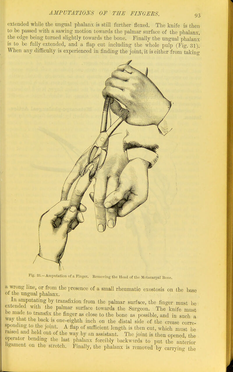93 extended while the ungual phalanx is still further flexed. The knife is then to be passed with a sawing motion towards the palmar surface of the phalanx, the edge being turned slightly towards the bone. Finally the ungual phalanx is to be fully extended, and a flap cut including the whole pulp (Fig. 31). When any difficulty is experienced in finding the joint, it is either from taking Fig. 33.-Amputation of a Finger. Removing the Heiul of tlio Metacarpal Bone. a wrong line, or from the presence of a small rheumatic exostosis on the base ot the ungual phalanx. In amputating by transfixion from the palmar surface, the finger must be extended with the palmar surface towards the Surgeon. The knife must be made to transfix the finger as close to the bone as possible, and in such -i way that the back is one-eighth inch on the distal side of the crease coiTe- spouc ing to the joint. A flap of sufficient length is then cut, which must be raised and held out of the way by an assistant. The joint is then opened the operator bending the last phalanx forcibly backwards to init the anterior ligament on the stretch. Finally, the phalanx is removed by carryino- the