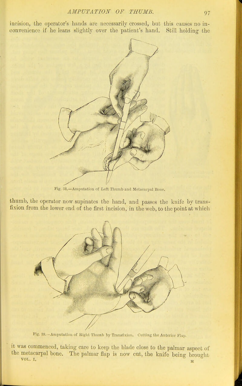 iucisiou, the operator's hands are necessarily crossed, but this causes no in- conveuience if he leans slightly over the patient's hand. Still holding the Fig. 38.—Ainputatiou of Left Tliumb and Metacarpal Bone. thumb, the operator now supinates the hand, and passes the knife by trans- fixion from the lower end of the first incision, in the web, to the point at which it was commenced, taking care to keep the blade close to the palmar aspect of the metacarpal bone. The palmar flap is now cut, the knife being brought