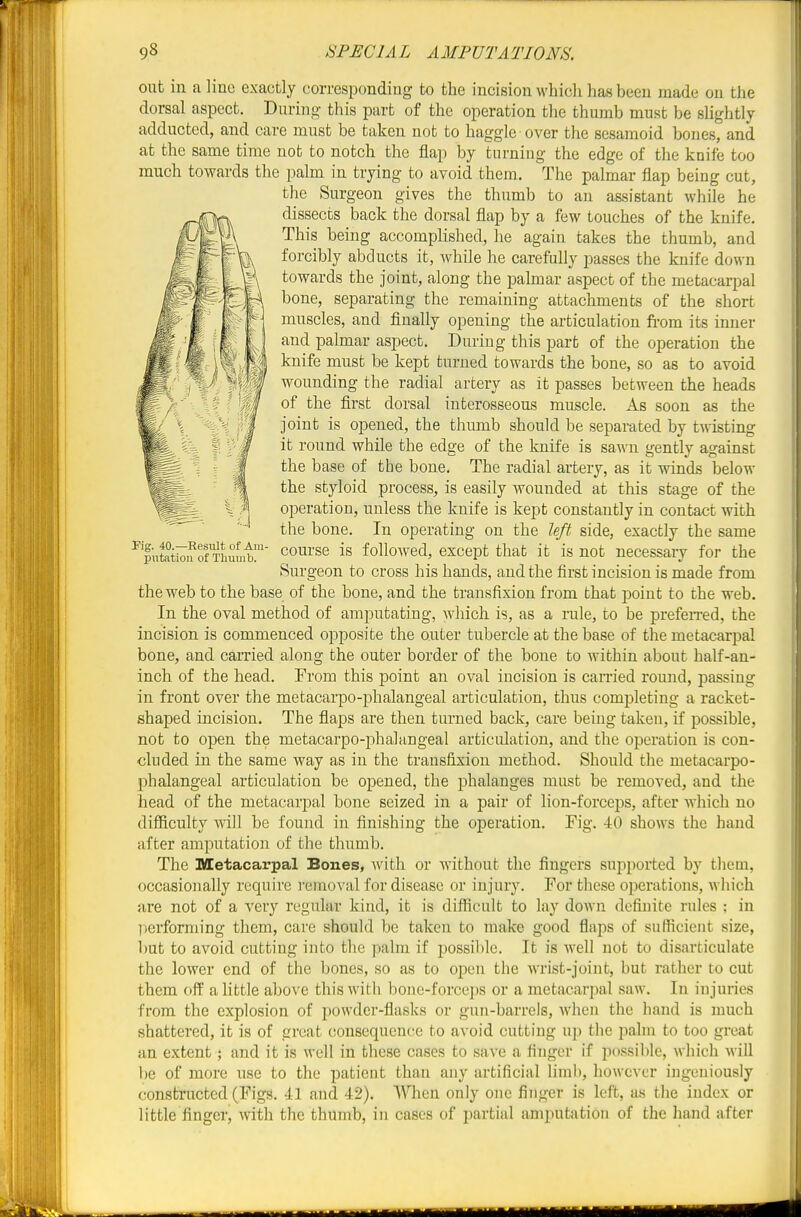 out in a line excacfcly corresponding to the incision wbicli lias been made on the dorsal aspect. During this part of the operation the thumb must be slightly adducted, and care must be taken not to haggle over the sesamoid bones, and at the same time not to notch the flap by turning the edge of the knife too much towards the palm in trying to avoid them. The palmar flap being cut, the Surgeon gives the thumb to an assistant while he dissects back the dorsal flap by a few touches of the knife. This being accomplished, he again takes the thumb, and forcibly abducts it, while he carefully passes the knife down towards the joint, along the palmar aspect of the metacarpal bone, separating the remaining attachments of the short muscles, and finally opening the articulation from its inner and palmar aspect. During this part of the operation the knife must be kept turned towards the bone, so as to avoid wounding the radial artery as it passes between the heads of the first dorsal interosseous muscle. As soon as the joint is opened, the thumb should be separated by twisting it round while the edge of the knife is sawn gently against the base of the bone. The radial artery, as it winds below the styloid process, is easily Avounded at this stage of the operation, unless the knife is kept constantly in contact with the bone. In operating on the left side, exactly the same course is followed, except that it is not necessary for the Surgeon to cross his hands, and the first incision is made from the web to the base of the bone, and the transfixion from that point to the web. In the oval method of amputating, which is, as a rule, to be prefeiTed, the incision is commenced opposite the outer tubercle at the base of the metacarpal bone, and carried along the outer border of the bone to within about half-an- inch of the head. From this point an oval incision is carried round, passing in front over the metacarpo-phalangeal articulation, thus completing a racket- shaped incision. The flaps are then turned back, care being taken, if possible, not to open the metacarpo-phalangeal articulation, and the operation is con- cluded in the same way as in the transfixion method. Should the metacarpo- phalangeal articulation be opened, the phalanges must be removed, and the head of the metacarpal bone seized in a pair of lion-forceps, after which no difiiculty will be found in finishing the operation. Fig. 40 shows the hand after amputation of the thumb. The Metacarpal Bones, with or without the fingers supported by them, occasionally require removal for disease or injury. For these operations, which are not of a very regular kind, it is difficult to lay down definite rules : in performing them, care should be taken to make good flaps of sutficient size, but to avoid cutting into the palm if possible. It is well not to disarticulate the lower end of the bones, so as to open the wrist-joint, but rather to cut them off a little above this with bone-forcejis or a metacarpal saw. In injuries from the explosion of powder-flasks or gun-barrels, when the hand is much shattered, it is of great consequence to avoid cutting up the palm to too great an extent ; and it is well in these cases to save a finger if possible, which Mill he of more use to the patient than any artificial limb, however ingeniously constructed (Figs. 41 and 42). When only one finger is left, as the index or little finger, with the thumb, in cases of partial amputation of the hand after putation of Thumb.