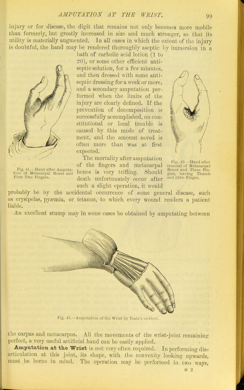 in jury or for disease, the digit that remains not only becomes more mobile than formerly, but greatly increased iu size and much stronger, so that its utility is materially augmented. In all cases in which the extent of the injury is doubtful, the hand may \)q rendered thoroughly aseptic by immersion in a bath of carbolic acid lotion (1 to 20), or some other efficient anti- septic solution, for a few minutes, and then dressed with some anti- septic dressing for a week or more, and a secondary amputation per- formed when the limits of the injury are clearly defined. If the prevention of decomposition is successfully accomplished, no con- stitutional or local trouble is caused by this mode of treat- ment, and the amount saved is often more than was at first expected. The mortahty after amputation of the fingers and metacarpal bones is very trifling. Should death unfortunately occur after such a slight operation, it would probably be by the accidental occurrence of some general disease, sucli as erysipelas, pytemia, or tetanus, to which every wound renders a patient liable. An excellent stump may in some cases be obtained by amputating between Fig. 41.—Huiid after Amputa- tiiju of Metacar])al Bones and First Two Finfjers. Fig. 42. -Hand after I'enioval of Metacarpal Bones and Tliree Fin- jrers, leaving Thumb and little Finger. Fig. 43.—Amputation of the Wrist by Teale's ineMioil. the carpus and metacarpus. All tlie movements of the wrist-joint remaining perfect, a very useful artificial hand can be easily a]:)])lied. Amputation at the Wrist is not very often retpiired. In performing dis-: articulation at this joint, its shape, with the convexity looking upwards, must be borne iu mind. The operation may be jierformed in two ways, n 2