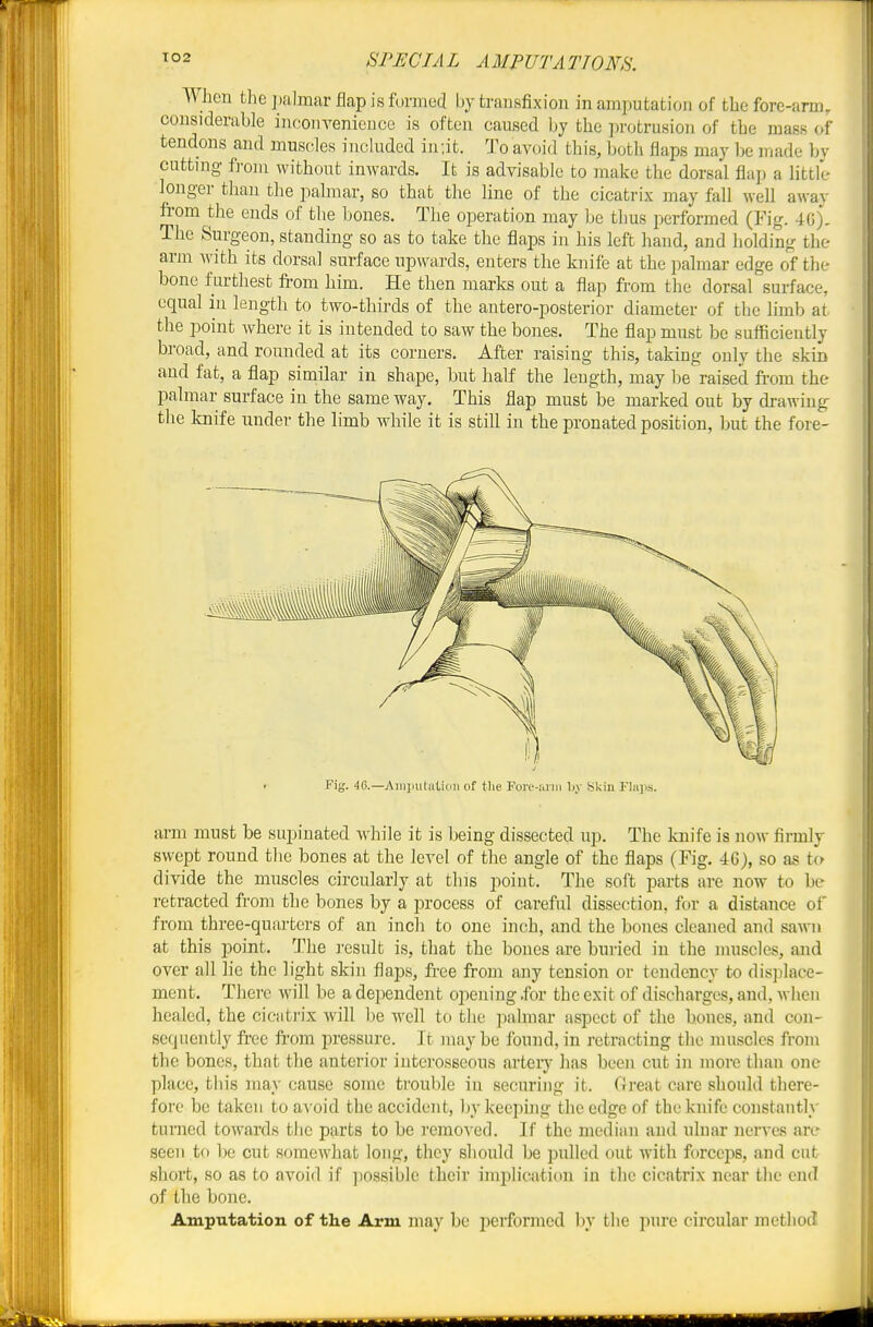 the ])almar flap is formed by transfixion in amputation of the fore-arm, considerable inooin-enieuce is ofteii caused by the protrusion of the mass of tendons and muscles included in;it. To avoid this, both flaps may lje made Ijy cutting f]-oiii without inwards. It is advisable to make the dorsal flap a little longer than the palmar, so that the line of the cicatrix may fall well away from the ends of the bones. The operation may be thus performed (Fig. The Surgeon, standing so as to take the flaps in his left hand, and holding the arm with its dorsal surface upwards, enters the knife at the palmar edge of the bone furthest from him. He then marks out a flap from the dorsal surface, equal in length to two-thirds of the antero-posterior diameter of the limb at the point where it is intended to saw the bones. The flap must be sufficiently broad, and romided at its corners. After raising this, taking only the skin and fat, a flap similar in shape, but half the length, may be raised from the palmar surface in the same way. This flap must be marked out by drawing the knife under the limb while it is still in the pronated position, but the fore- Fig. 46.—Ainiiutatidii of the Foi'i'-nna \>y Skin Flaps. arm must be supiuated while it is being dissected up. The knife is now firmly swept round the bones at the level of the angle of the flaps (Fig. 46), so as t(^ divide the muscles circularly at this point. The soft parts are now to be retracted from the bones by a process of careful dissection, for a distance of from three-quarters of an inch to one inch, and the bones cleaned and sawn at this point. The result is, that the bones are buried in the muscles, and over all lie the light skin flaps, free from any tension or tendency to displace- ment. There Avill be a dependent opening -for the exit of discharges, and, when healed, the cicati-ix wnll be well to the ]ialmar aspect of the bones, and con- sequently free from pressure. It maybe found,in retracting the nniscles from the bones, that the anterior interosseous arteiy has been cut in more than one place, this }nay cause some trouble in securing it. Great care should there- fore be taken to avoid the accident, bykeepuig the edge of the knife constantly turned towards the parts to be remoA ed. If the median and ulnar nerves are seen to be cut somewhat long, they should be pulled out with forceps, and cut short, so as to avoid if possible their implication in the cicatrix near the end of the bone. Amputation of the Arm may be i)erformed by the pure circular method!