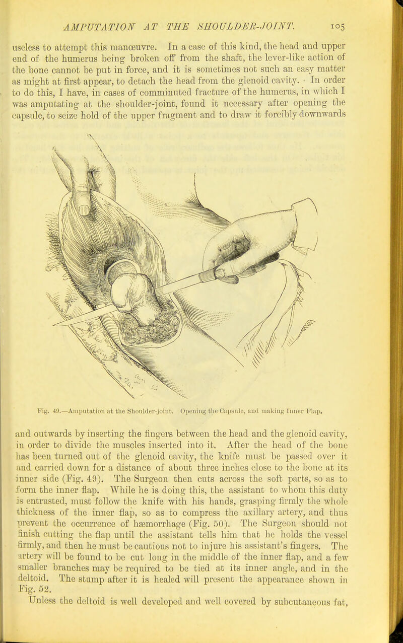useless to attempt this manoeuvre. In a case of this kind, the head and upper end of the humerus being broken off from tlie shaft, the lever-Kke action of the bone cannot be put in force, and it is sometimes not such an easy matter as might at first appear, to detach the head from the glenoid cavity. • In order to do this, I have, in cases of comminuted fracture of the humerus, in wliich I was amputating at the shoulder-joint, found it necessary after opening the capsule, to seize hold of the upper fragment and to draw it forcibly downwards Fig. 49.—Amputation at the ShouUler-joint. Opening tla' Capsule, and making Innei' Flap. and outwards by inserting the fingers between the head and the glenoid cavity, in order to divide the muscles inserted into it. After the head of the bono lias been turned out of the glenoid cavity, the knife must be passed ovei' it and carried down for a distance of about three inches close to the bone at its inner side (Fig. 49). The Surgeon then cuts across the soft parts, so as to form the inner flap. While he is doing this, the assistant to whom tliis duty is entrusted, must follow the knife with his hands, grasping firmly the wliolc thickness of the inner flap, so as to compress the axillary artery, and thus prevent the occurrence of hasmorrhage (Fig. 50). The Surgeon should not finish cutting the flap until the assistant tells him that he holds the vessel firmly, and then he must be cautious not to injure his assistant's fingers. The artery will be found to be cut long in the middle of the inner flap, and a few smaller branches may be required to be tied at its inner angle, and in the deltoid. The stump after it is healed will present the appearance shown in Fig. 52. Unless the deltoid is well developed and well covered by subcutaneous fat,