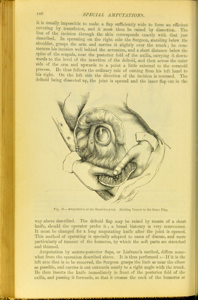 it is usually impossible to make a flap suiTiciently wide to fom an efficient covcrmg l)y ti-ansfixion, aucl it must then be raised by dissection. The hue of tlie incision through the skin corresponds exactly witli tliat just described. In operating on the right side the Surgeon, standing below the shoulder, grasps the arm and carries it slightly over the trunk; he com- mences his incision well behind the acromion, and a short distance below the spme of the scapula, near the posterior fold of the axilla, carrying it down- wards to the level of the insertion of the deltoid, and then across the outer side of the arm and upwards to a point a little external to the coracoid process. He thus follows the ordinary rule of cutting from his left hand to his right. ^ On the left side the direction of the incision is reversed. The deltoid being dissected up, the joint is opened and the inner flap cut in the Avay above described. The deltoid flap may be raised by means of a short knife, should the operator prefer it; a broad bistoury is very convenient. It must be changed for a long amputating knife after the joint is opened. This meth(xl of operating is specially adapted to cases of disease, and more ]mrticularly of tumour of the humerus, by which the soft parts are stretched and thinned. Amputation by antero-posterior flaps, or Lisfrauc's method, diflTers some- what from the operation described abo\ e. It is thus performed :—If it is the left arm that is to be rejuoved, the Surgeon grasps the limb as near the elbow as possible, and carries it out outwards nearly to a right angle with the trunk. He then inserts the knife immediately in front of the jiosterior fold of the axilla, and jjassing it forwards, so that it crosses the neck of the humerus at