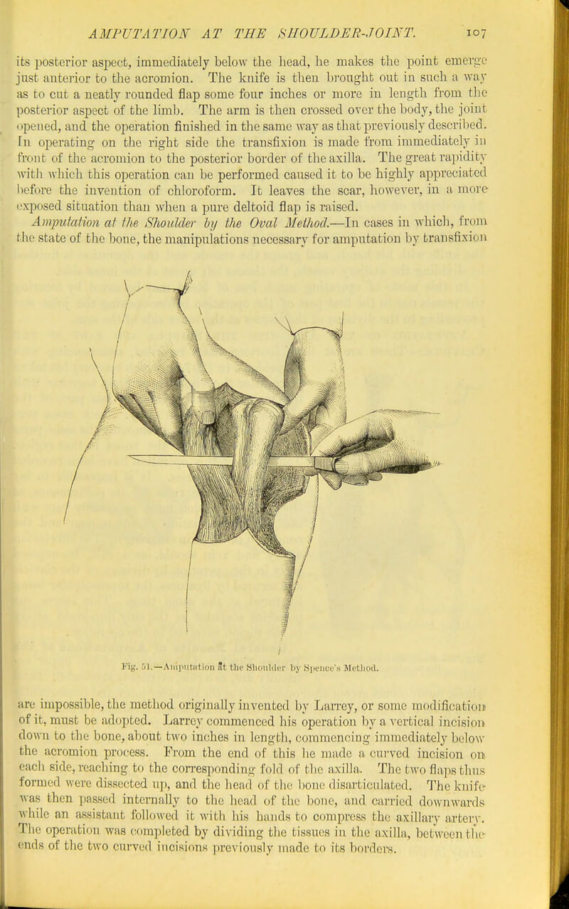 its posterior asi^ect, immediately below the head, he makes the point emergx' just anterior to the acromion. The knife is then brought out in such a way as to cut a neatly rounded flap some four inches or more in length from the posterior aspect of the limb. The arm is then crossed over the body, the joint opened, and the operation finished in the same way as that previously described. In ojierating on the right side the transfixion is made from immediately in front of the acromion to the posterior border of the axilla. The great rapidity with which this operation can be performed caused it to be highly appreciated before the invention of chloroform. It leaves the scar, however, in a more exposed situation than Avhen a pure deltoid flap is raised. Amputation at the Shouldei- iij the Oval Method.—In cases in which, froni tlip state of the bone, the manipulations necessary for amputation by transfixion Fig. Aiii]ii\l!ition at the Slioulder by ^pence's Method. are impossible, the method originally invented by Larrey, or some modificatiom of it, must be adopted. Larrey commenced his operation by a A^ertical incision down to the bone, about two inches in length, commencing immediately below the acromion process. From the end of this he made a curved incision on each side, reaching to the con-esponding fold of the axilla. The tAvo flaps thus formed were dissected up, and the head of the bone disarticulated. The knife Avas then passed internally to the head of the bone, and carried downwards Avhile an assistant followed it Avitli his hands to compress the axillary artery. The operation Avas completed by dividing the tissues in the axilla, between the- ends of the tAvo curved incisions previously made to its borders.