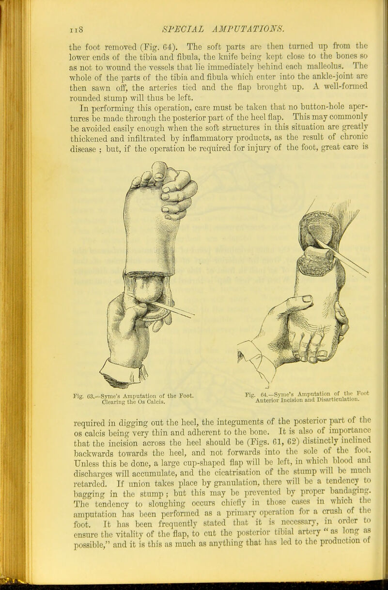 the foot removed (Fig. 64). The soft parts are then turned up from the lower ends of the tibia and fibula, the knife bein^? kept close to the bones so as not to wound the vessels that lie immediately behind each malleolus. The whole of the parts of the tibia and fibula which enter into the ankle-joint are then sawn off, the arteries tied and the flap brought up. A well-formed rounded stump will thus be left. In performing this operation, care must be taken that no button-hole aper- tures be made through the posterior part of the heel flap. This may commonly be avoided easily enough when the sofb structures in this situation are greatly thickened and infiltrated by inflammatory products, as the result of chronic disease ; but, if the operation be required for injury of the foot, great care is Fig. 63.-Syme's Amputation of the Foot. Fig. 64.-S5niie's Amputation of the F Clearing the Os Calcis. Anterior Incision and Disarticulation. required in digging out the heel, the integuments of the posterior part of the OS calcis being very thin and adherent to the bone. It is also of importance that the incision across the heel should be (Figs. 61, 62) distinctly inchned backwards towards the heel, and not forwards into the sole of the foot. Unless this be done, a large cup-shaped flap will be left, in which blood and discharges will accumulate, and the cicatrisation of the stump wiU be much retarded. If union takes place by granulation, there will be a tendency to bagging in the stump ; but this may be prevented by proper bandaging. The tendency to sloughing occurs chiefly in those cases m which the amputation has been performed as a primary operation for a crush of the foot. It has been frequently stated that it is necessary, m order to ensure the vitality of the flap, to cut the posterior tibial artery as long as possible, and it is this as much as anything that has led to the production ot