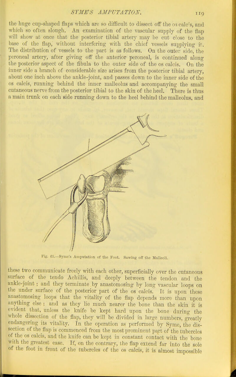 the huge cup-shaped flaps -which are so cliflBculfc to dissect off the 03 calo's, and which so often slough. An examination of the vascular supply of the flap will show at once that the posterior tibial artery may be cut close to the base of the flap, without interfering with the chief vessels supplying if. The distribution of vessels to the part is as follows. On the outer side, the peroneal artery, after giving off the anterior peroneal, is continued along the posterior aspect of the fibula to the outer side of the os calcis. On the inner side a branch of considerable size arises from the posterior tibial artery, about one inch above the ankle-joint, and passes down to the inner side of the OS calcis, running behind the inner malleolus and accompanying the small cutaneous nerve from the posterior tibial to the skin of the heel. There is thus a main trunk on each side running down to the heel behind the malleolus, and Fig. 60.—Syme's Amputation of tlie Foot. Sawing off the Malleoli. these two communicate freely with each other, superficially over the cutaneous surface ol the tendo AchiUis, and deeply between the tendon and the ankle-joint ; and they terminate by anastomosing by long vascular loops on the under surface of the posterior part of the os calcis. It is upon these anastomosing loops that the vitality of the flap depends more than upon anything else ; and as they lie much nearer the bone than the skin it is evident that, unless the knife be kept hard upon the bone during the whole dissection of the flap, they will be divided in large numbers, greatly endangering its vitality. In the operation as performed by Syme, the dis- section of the flap is commenced from the most prominent part of the tubercles of the 08 calcis, and the knife can be kept in constant contact with the bone with the greatest ease. If, on the contrary, the flap extend far into the sole of the foot in front of the tubercles of the os calcis, it is almost impossible