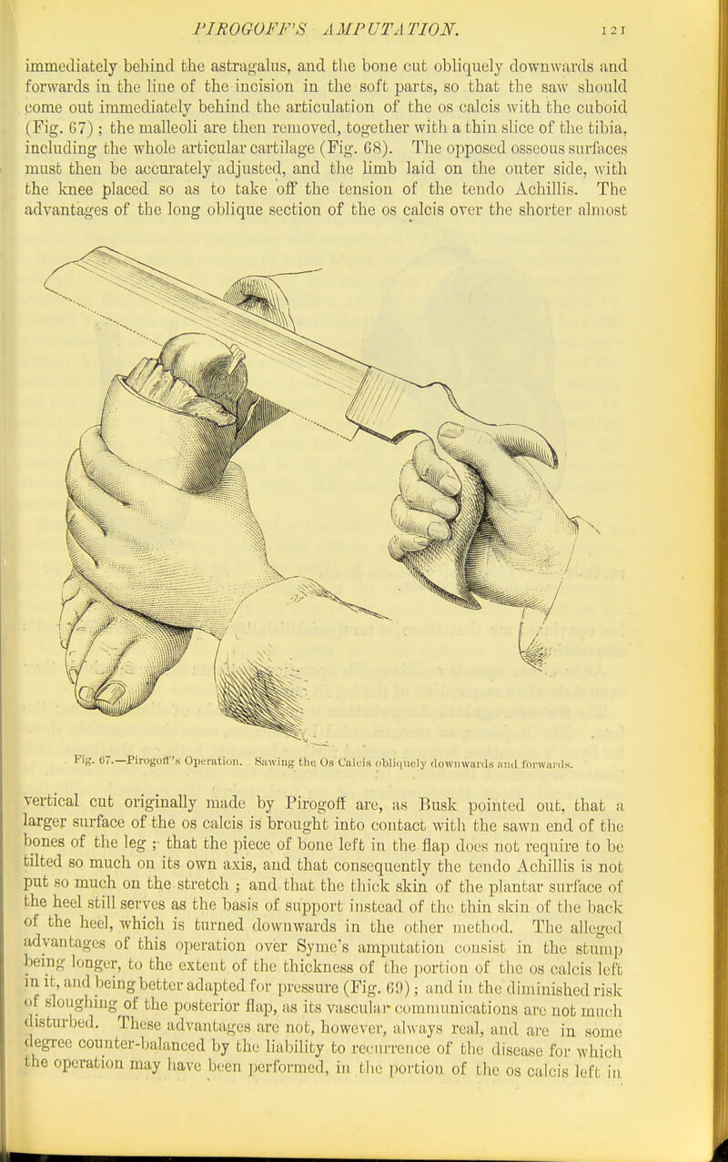 immediately behind the astragalus, and the bone cut obliquely downwards and forwai'ds in the line of the incision in the soft parts, so that the saw should come out immediately behind the articulation of the os calcis with the cuboid (Fig. 67) ; the malleoli are then removed, together with a thin slice of the tibia, including the whole articular cartdage (Fig. 68). The ojoposed osseous surfaces must then be accurately adjusted, and the limb laid on the outer side, with the knee placed so as to take off the tension of the tendo Achillis. The advantages of the long oblique section of the os calcis over the shorter almost Fig. b7.—Pirogotr's Operation. Sawing tli« Os Calcis dbliiinely downwards and forwards. vertical cut originally made by Pirogoff arc, as Busk pointed out, that a larger surface of the os calcis is brought into contact with the sawn end of the bones of the leg ;• that the piece of bone left in the flap does not require to be tilted so much on its own axis, and that consequently the tendo Achillis is not put so much on the stretch ; and that the thick skin of the plantar surface of the heel still serves as the basis oP support instead of the thin skin of the back of the heel, which is turned downwards in the other method. The alleged advantages of this operation over Syme's amputation consist in the stump being longer, to the extent of the thickness of the ]wrtion of the os calcis left in It, and being better adapted for pressure (Fig. 69); and in the diminished risk of sloughing of the posterior flap, as its vascular communications are not much disturbed. These advantages are not, however, always real, and are in some degree counter-balanced by the liability to recurrence of the disease for which the operation may have been performed, in the portion of the os calcis left in.