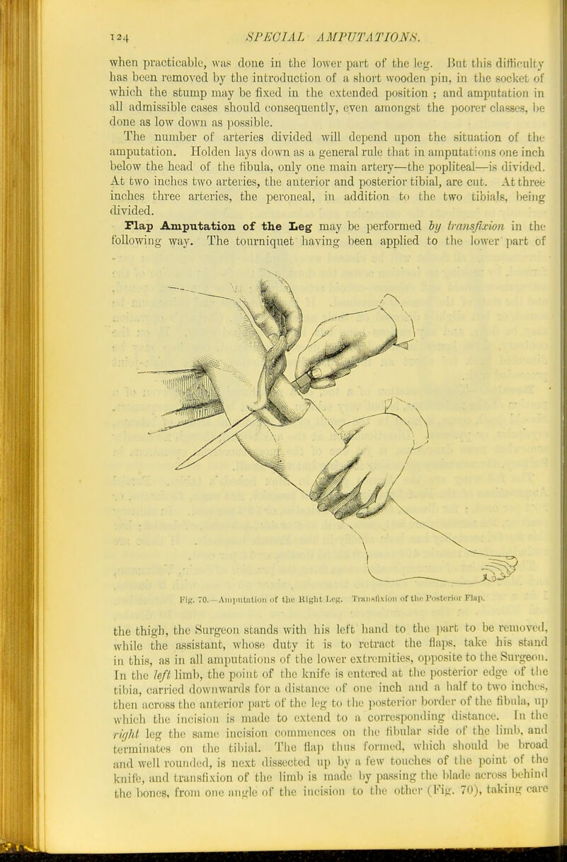 when practicable, was done in tlie lower part of the lej^. But this dittifiilty has been removed by the introduction of a short wooden pin, in the socket of which the stump may be fixed in the extended position ; and amputation in all admissible cases should consequently, even amongst the poorer classes, l)e done as low down as jwssible. The number of ai'teries divided will depend upon the situation of the amputation. Plolden lays down as a general rule that in amputations one inch below the head of the fibula, only one main artery—the popliteal—is divided. At tW'O inches two arteries, the anterior and posterior tibial, are cut. At three inches three arteries, the peroneal, in addition to the two tibials, Iteing divided. Flap Amputation of the Leg may be performed hy tramfixion in the following way. The tourniquet having been applied to the lower ]iart of TO. AiiiimtatioM of tlii; Eight Lck. ■JVaiislixioii of tin- rosU'riui- Flap. the thigh, the Surgeon stands with his left hand to the part to be removed, while the a.ssistant, whose duty it is to retract the flaps, take his stand in this, as in all amputations of the lower extremities, opposite to the Surgeon. In the hfl limb, the point of the knife is entered at the posterior edge of tiie tibia, cari-ied downwards for a distance of one inch and a half to two inches, then across the anterior part of the leg to the jiosterior border of the fibula, up which the incision is made to extend to a corresponding distance. In the rigU leg the same incision commences on the fibular side of the limb, and terminates on the tibial. The flap thns formed, which should be broad and well rounded, is next dissected up by a few touches of tlie point of the knife, and transfixion of the limb is made Ijy passing the blade acros.s behind the bones, from one angle of the incision to the other (Fig. 70), taking care