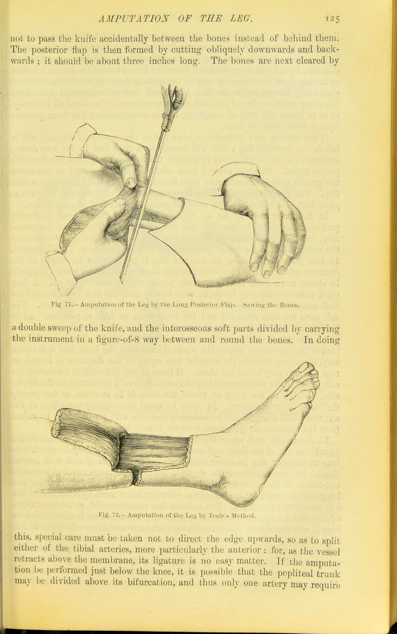 not to pass the knife accideutally between the bones instead of behind them. The posterior flap is then formed by cutting obliquely downwards and back- wards ; it should be about three inches long-. The bones are next cleared by Fig 11.—AMi|iiit;iti(in (if tlic Let; by tlie Liiii;^ PiLstfriiir Siiuiiig tlir Riiikw. a double swee]D uf the knife, and the interosseous soft parts divided by cari yiug the instrmneut in a figure-of-8 way between and round the bones. In doing Fig. 7-J.- AliipuUaiiil] (il'tlic by 'I'ddc's .Mrtliml. this, sjiecial care nuist be taken not to direct the edge upwards, so as to split either of the tibial arteries, more particularly the anterior : for, as the vessel retracts above the membrane, its ligature is )io easy matter. Jf the amputa- tion he ])erformed just below the knee, it is ])ossible that the popliteal trunk may be divided above its bifurcation, and thus only one artery may require