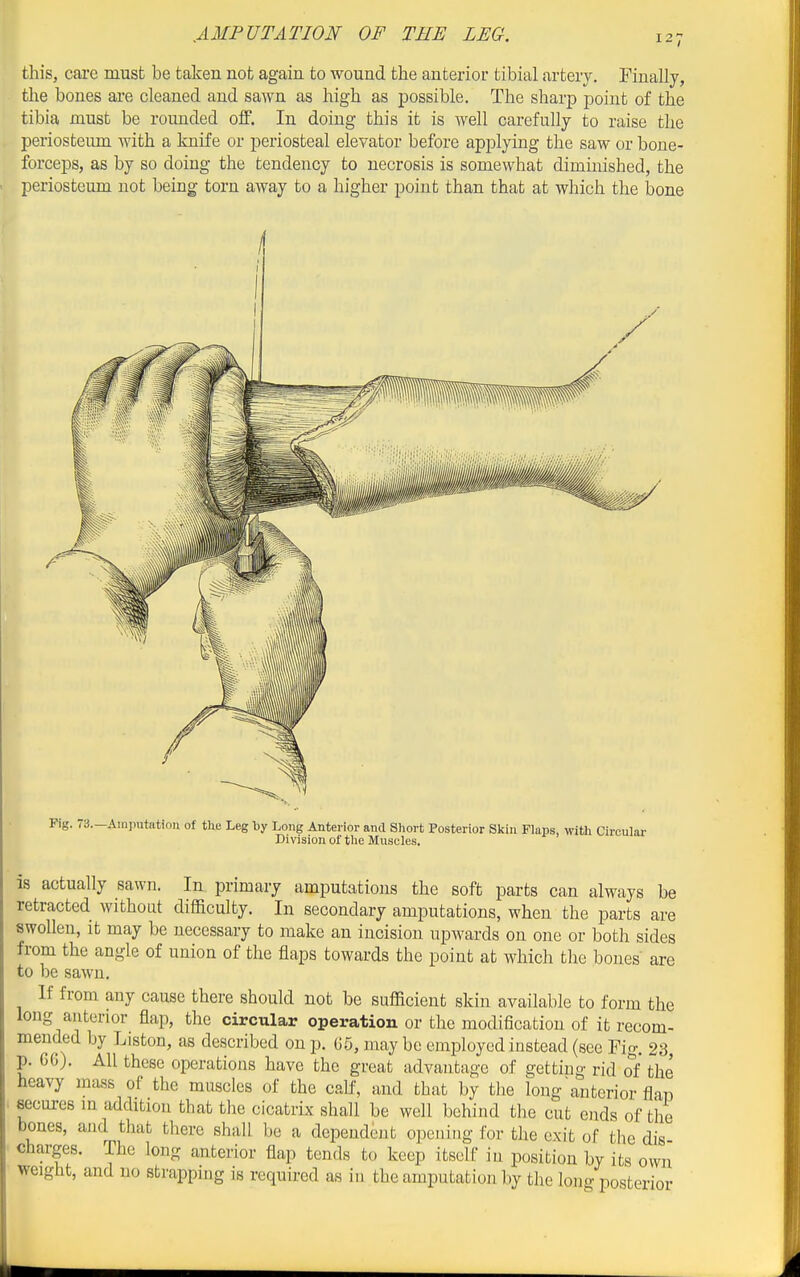 this, cai'e must be taken not again to wound the anterior tibial artery. Finally, the bones are cleaned, and sawn as high as possible. The sharp point of the tibia must be rounded off. In doing this it is well carefully to raise the periosteum with a knife or periosteal elevator before applying the saw or bone- forceps, as by so doing the tendency to necrosis is somewhat diminished, the periosteum not being torn away to a higher point than that at which the iDone Fig. 73.-Ainputation of the Leg by Long Anterior and Sliort Posterior Skin Flaps, with Circular Division of the Muscles, is actually sawn. In primary amputations the soft parts can always be retracted without difficulty. In secondary amputations, when the parts are swollen, It may be necessary to make an incision upwards on one or both sides from the angle of union of the flaps towards the point at which the bones are to be sawn. If from any cause there should not be sufficient skin available to form the long anterior flap, the circular operation or the modification of it recom- mended by Listen, as described on p. 65, may be employed instead (see Pig. 23 p. GG). All these operations have the great advantage of getting rid of the heavy mass of the muscles of the calf, and that by tlie long anterior flan secures in addition that the cicatrix shall be well behind the cut ends of the bones, and that there shall be a dependent opening for the exit of the dis charges. The long anterior flap tends to keep itself in position by its own weight, and no strapping is required as in the amputation by the long posterior