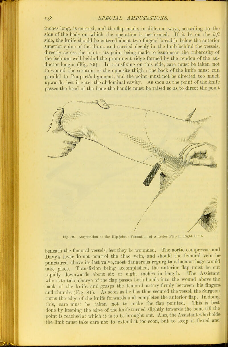 inches long, is entered, and the flap made, in different ways, according to the side of the body on which the operation is performed. If it T^e on the Ufi side, the knife slionld be entered aljout two fingers' breadth below the anterioi- superior spine of the ilium, and carried deeply in the limb behind the vessels, directly across the joint; its point being made to issue near the tuberosity of the ischium well behind the prominent ridge foi-med by the tendon of the ad- ductor longus (Fig. 79). In transfixing on this side, care must be taken not to wound the scrotum or the opposite thigh ; the back of the knife must run parallel to Poupart's ligament, and the point must not be directed too much upwards, lest it enter the abdominal cavity. As soon as the point of the knife passes the head of the bone the handle must be raised so as to direct the point, Fig. SO.—Aiiiputation at tlip Hip-joint: Kornuition of Antorior Plaj) in Right. Limb. beneath the femoral vessels, lest they be wounded. The aortic compressor and Davy's lever do not control the iliac vein, and should the femoral vein be- punctured above its last valve, most dangerous regurgitant haemorrhage would take place. Transfixion being accomplished, the anterior flap must be cut i-apidly downwards about six or eight inches in It-ngth. The Assistant who is to take charge of tbc fla]) passes l)oth hands into the wound above the back of the knife, and grasps the femoral artery firmly between his fingers- and thuml)s (Tig. 81). As soon as he has thus secured the vessel, the Surgeon turns the edge of the knife forwards and comjiletes the anterior flap. In doing this, care must be taken not to make the fla^i pointed. This is best done by keeping the edge of the knife tunied slightly towards the bone till the point is reached at which it is to be brought out. Also, the Assistant who holds the limb must take care not to extend it too soon, but to keep it flexed and