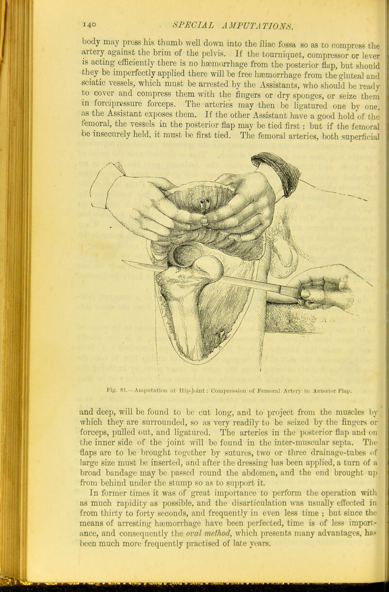 body may press his thumb well down into the iliac fossa so as to compress tlie m-fcery against the brim of the pelvis. If the tourniquet, compressor or lever IS acting efficiently there is no htemorrhage from the postei'ior flap, but should they be imperfectly applied there will be free ha3morrhage from the gluteal and sciatic ATSsels, which must be arrested by the Assistants, who should be ready to cover and compress them with the fingers or dry sponges, or seize theni in forciprcssure forceps. The arteries may then be ligatured one by one, jxs the Assistant exposes them. If the other Assistant have a good hold of the femoral, the vessels in the posterior flap may be tied fii-st; but if the femoi-al be insecurely held, it must be first tied. The femoral arteries, both superficial Mg. 81.—Aiiiputatioii lit IIi|i-ii)int : Coni]ii-n.sMi(iii of Fciiinnil Arti-iy in Aiu<-riiir Flap. and deep, will be found to be cut long, and to project from the muscles ]iy which they are suiTounded, so as very readily to be seized by the fingers or forceps, pulled out, and ligatured. The arteries in the posterior flap and (ni the inner side of the joint will be found in the inter-muscular septa. The flaps are to be brought together by sutures, two or three drainage-tubes nf large size must be inserted, and after the dj-essing has been applied, a turn of a broad bandage may be passed round the abdomen, and the end brought u]i from behind under the stump so as to sujiport it. In former times it was of great importance to perform the operation with as much rapidity as possible, and the disarticulation was usually effected in from thirty to forty seconds, and frequently in even less time ; but since the means of arresting httmorrhage have been perfected, time is of less import- ance, and consequently the oval inethod, which ])resents many advantages, has been much more frequently practised of late years.