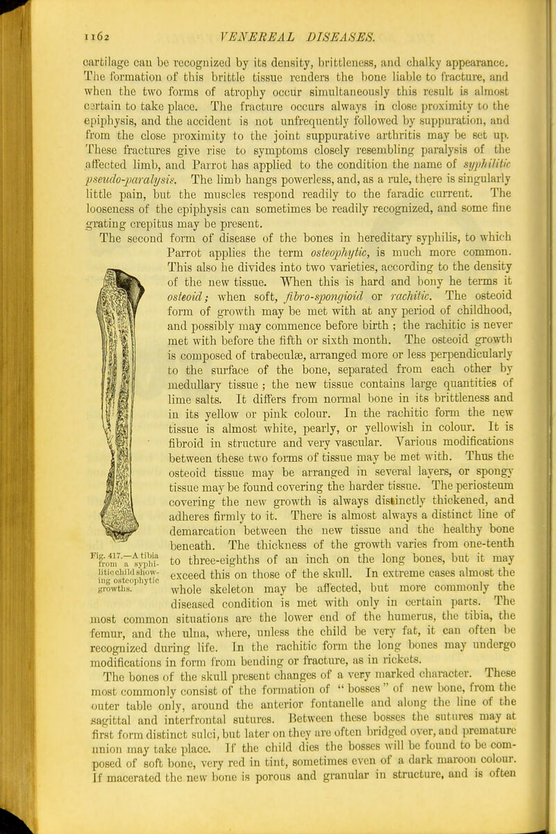 I I cartilage cau be recognized by its density, brittlencss, and chalky appearance. The formation of this brittle tissue renders the bone liable to iracture, and when the two forms of atrophy occur simultaneously this result is almost C3rtain to take place. The fracture occurs always in close proximity to the epiphysis, and the accident is not unfrequently followed by suppuration, and from the close proximity to the joint suppurative arthritis may be set up. These fractures give rise to symptoms closely resembling paralysis of the affected limb, and Parrot has applied to the condition the name of s^jphiUtic pseudo-j)arahjsu: The limb hangs powerless, and, as a rale, there is singularly Httle pain, but the muscles respond readily to the faradic cuiTent. The looseness of the epiphysis can sometimes be readily recognized, and some fine grating crepitus may be present. The second form of disease of the bones in hereditary syphilis, to which Parrot applies the term osteophytic, is much more common. This also he divides into two varieties, according to the density of the new tissue. When this is hard and bony he terms it osteoid; when soft, flbro-spongioid or rachitic. The osteoid form of growth may be met with at any period of childhood, and possibly may commence before birth ; the rachitic is never met with before the fifth or sixth month. The osteoid growtli is composed of trabeculag, arranged more or less perpendicularly to the surface of the bone, separated from each other by medullary tissue ; the new tissue contains large quantities of lime salts. It differs from normal bone in its brittleness and in its yellow or pink colour. In the rachitic form the new tissue is almost white, pearly, or yellowish in colour. It is fibroid in structure and very vascular. Various modifications between these two forms of tissue may be met with. Thus the osteoid tissue may be arranged in several layers, or spong}- tissue may be found covering the harder tissue. The periosteum covering the new growth is always distinctly thickened, and adheres firmly to it. There is almost always a distinct line of demarcation between the new tissue and the healthy bone beneath. The thickness of the gi'owth varies from one-tenth to three-eighths of an inch on the long bones, but it may exceed this on those of the skull. In extreme cases almost the whole skeleton may be affected, but more commonly the diseased condition is met with only in certain parts. The most common situations are the lower end of the humerus, the tibia, the femui-, and the ulna, where, unless the child be very fat, it can often be recognized during life. In the rachitic form the long bones may undergo modifications in form from bending or fractm-e, as in rickets. The bones of the skull present changes of a very marked character. These most commonly consist of the formation of bosses of new bone, from the outer table only, around the anterior fontanelle and along the line of the sagittal and interf'rontal sutures. Between these bosses the sutures may at first form distinct sulci, but later on they are often bridged over, and premature union may take place. If the child dies the bosses will be found to bo com- posed of soft bone, very red in tint, sometimes even of a dark maroon colour. If macerated the new bone is porous and granular in structure, and is often Fig. 417.—A tibia from a sj-phi- litiocliild show- ing ostcojihytic growtlis.