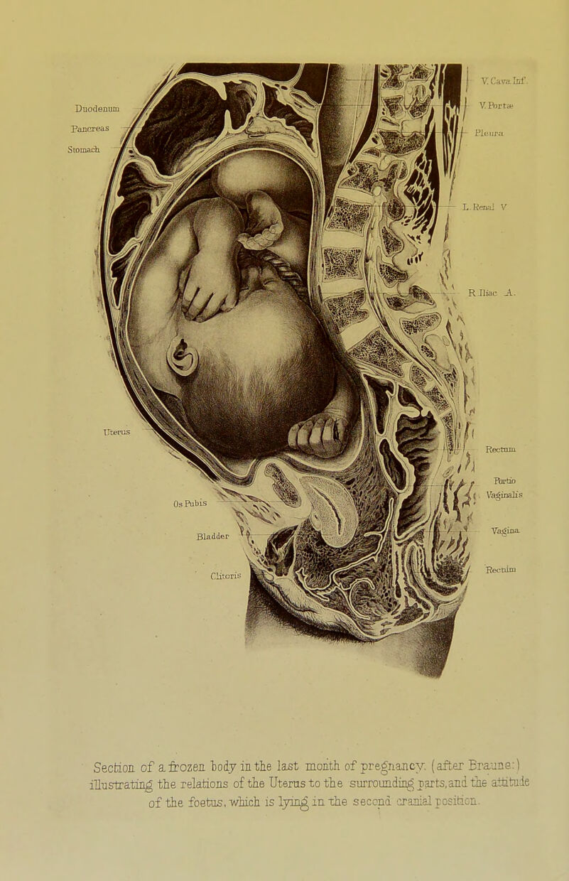 Section of a frozen loiy in the last month of pregnancy, (after Braune:) illustrating the relations of the Uterus to the surrounding T.arts.and the attitude of the foetus, which is lyings in the second cranial positicn.