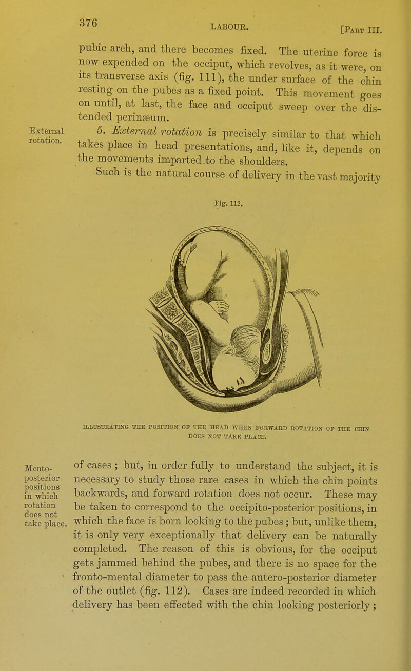 LABOUR. [Paiit III. pubic arch, and there becomes fixed. The uterine force is now expended on the occiput, which revolves, as it were, on its transverse axis (fig. Ill), the under surface of the chin resting on the pubes as a fixed point. This movement goes on until, at last, the face and occiput sweep over the dis- tended perinseum. External 5. External rotation is precisely similar to that which rotation. takeg pkce in presentationS) ^ ^ ^ dependg Qn the movements imparted.to the shoulders. Such is the natural course of delivery in the vast majority Fig. 112. ILLUSTRATING THE POSITION OF THE HEAD WHEN FORWABD DOTATION OP THE CHIN DOES NOT TAKR PLACE. Mento- °f cases '> but, in order fully to understand the subject, it is posterior necessary to study those rare cases in which the chin points m which backwards, and forward rotation does not occur. These may doe^not ^e taken to correspond to the occipito-posterior positions, in take place, which the face is born looking to the pubes; but, unlike them, it is only very exceptionally that delivery can be naturally completed. The reason of this is obvious, for the occiput gets jammed behind the pubes, and there is no space for the • fronto-mental diameter to pass the antero-posterior diameter of the outlet (fig. 112). Cases are indeed recorded in which delivery has been effected with the chin looking posteriorly;