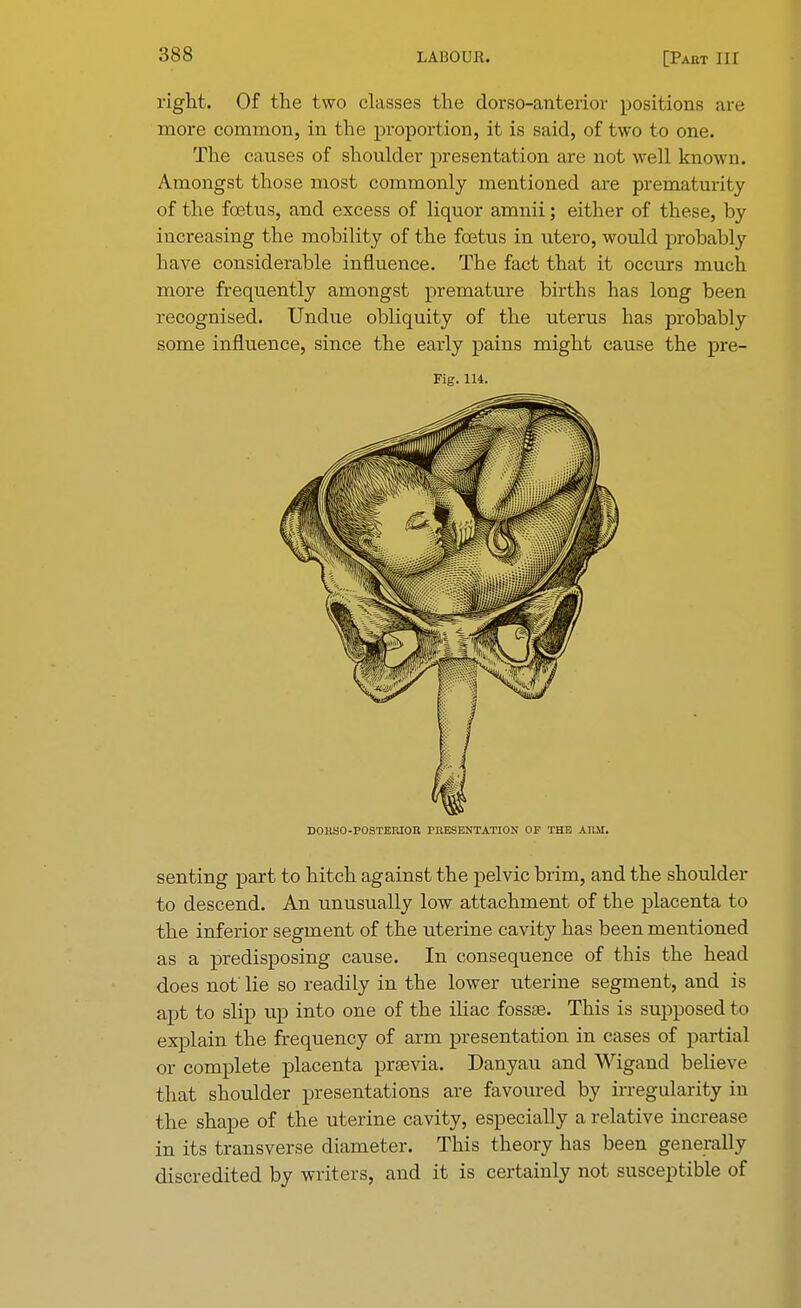 right. Of the two classes the dorsc-anteriov positions are more common, in the proportion, it is said, of two to one. The causes of shoulder presentation are not well known. Amongst those most commonly mentioned are prematurity of the foetus, and excess of liquor amnii; either of these, hy increasing the mobility of the foetus in utero, would probably have considerable influence. The fact that it occurs much more frequently amongst premature births has long been recognised. Undue obliquity of the uterus has probably some influence, since the early pains might cause the pre- Fig. 114. DOHSO-POSTERIOR PRESENTATION OF THE AIM. senting part to hitch against the pelvic brim, and the shoulder to descend. An unusually low attachment of the placenta to the inferior segment of the uterine cavity has been mentioned as a predisposing cause. In consequence of this the head does not' lie so readily in the lower uterine segment, and is apt to slip up into one of the iliac fossae. This is supposed to explain the frequency of arm presentation in cases of partial or complete placenta prsevia. Danyau and Wigand believe that shoulder presentations are favoured by irregularity in the shape of the uterine cavity, especially a relative increase in its transverse diameter. This theory has been generally discredited by writers, and it is certainly not susceptible of