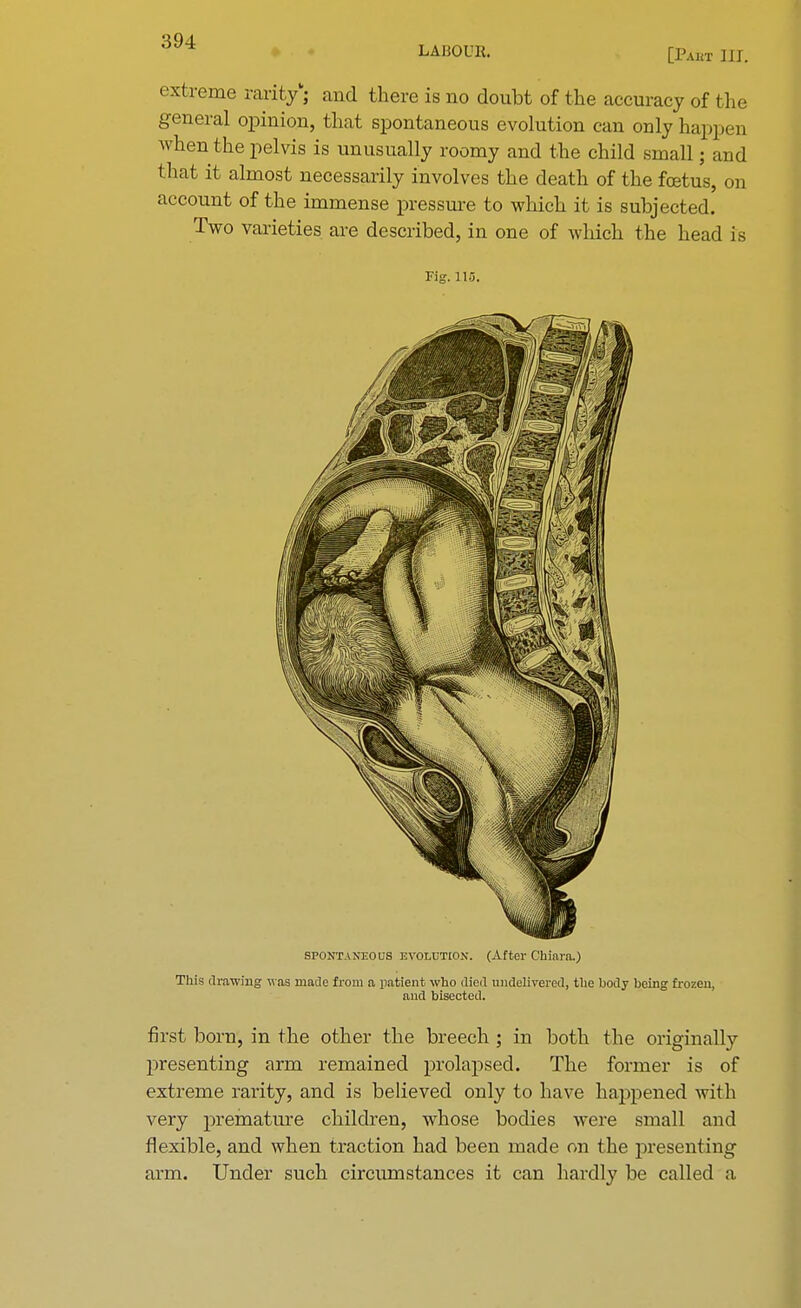 LAIiOUli. [Paht III. extreme rarity; and there is no doubt of the accuracy of the general opinion, that spontaneous evolution can only happen when the pelvis is unusually roomy and the child small; and that it almost necessarily involves the death of the foetus, on account of the immense pressure to which it is subjected. Two varieties are described, in one of which the head is Fig. 115. spontaneous evolution. (After Chiara.) This drawing was made from a patient who died undelivered, the body being frozen, and bisected. first born, in the other the breech ; in both the originally presenting arm remained prolapsed. The former is of extreme rarity, and is believed only to have happened with very premature children, whose bodies were small and flexible, and when traction had been made on the presenting arm. Under such circumstances it can hardly be called a