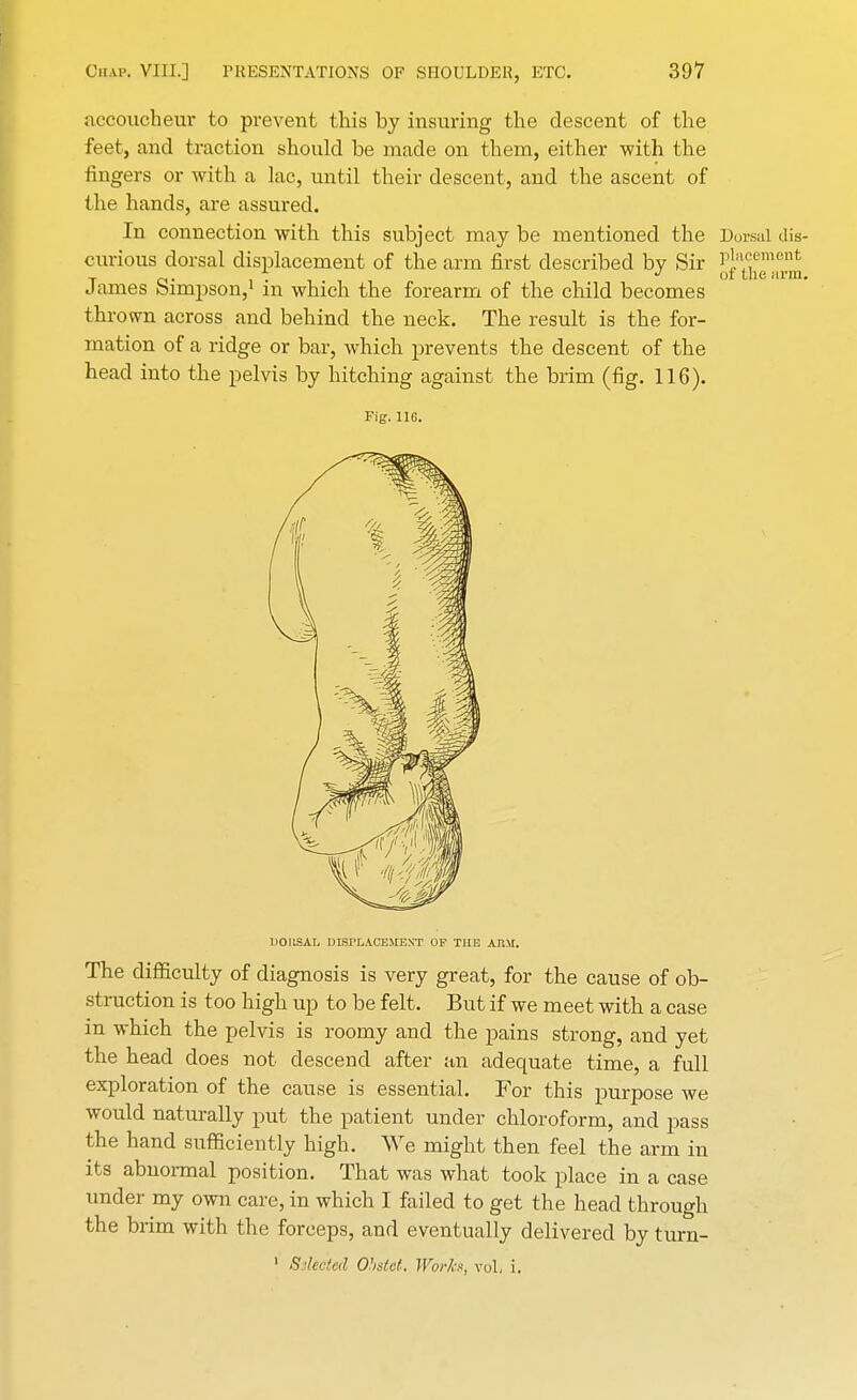 accoucheur to prevent this by insuring the descent of the feet, and traction should be made on them, either with the fingers or with a lac, until their descent, and the ascent of the hands, are assured. In connection with this subject may be mentioned the Dorsal dis- curious dorsal displacement of the arm first described by Sir jj1^^ James Simpson,1 in which the forearm of the child becomes thrown across and behind the neck. The result is the for- mation of a ridge or bar, which prevents the descent of the head into the pelvis by hitching against the brim (fig. 116). Pig. 116. 1JOUSAL DISPLACEMENT OP THE AIIM. The difficulty of diagnosis is very great, for the cause of ob- struction is too high up to be felt. But if we meet with a case in which the pelvis is roomy and the pains strong, and yet the head does not descend after an adequate time, a full exploration of the cause is essential. For this purpose we would naturally put the patient under chloroform, and pass the hand sufficiently high. We might then feel the arm in its abnormal position. That was what took place in a case under my own care, in which I failed to get the head through the brim with the forceps, and eventually delivered by turn- 1 Sslected Ohstet. Works, vol, i.