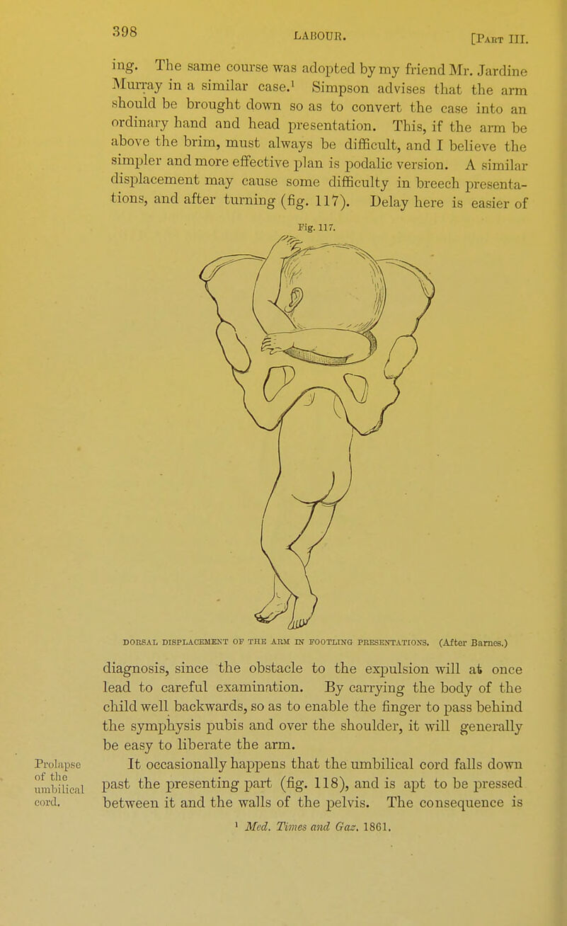 [Paut III. ing. The same course was adopted by my friend Mr. Jardine Murray in a similar case.1 Simpson advises that the arm should be brought down so as to convert the case into an ordinary hand and head presentation. This, if the arm be above the brim, must always be difficult, and I believe the simpler and more effective plan is podalic version. A similar displacement may cause some difficulty in breech presenta- tions, and after turning (fig. 117). Delay here is easier of Fig. 117. DORSAL DISPLACEMENT OP THE ARM IN FOOTLING PRESENTATIONS. (After Barnes.) diagnosis, since the obstacle to the expulsion will at once lead to careful examination. By carrying the body of the child well backwards, so as to enable the finger to pass behind the symphysis pubis and over the shoulder, it will generally be easy to liberate the arm. Prolapse It occasionally happens that the umbilical cord falls down umbilical Pas^ the Presenting part (fig. 118), and is apt to be pressed cord. between it and the walls of the pelvis. The consequence is 1 Med. Times and Gaz. 1861.