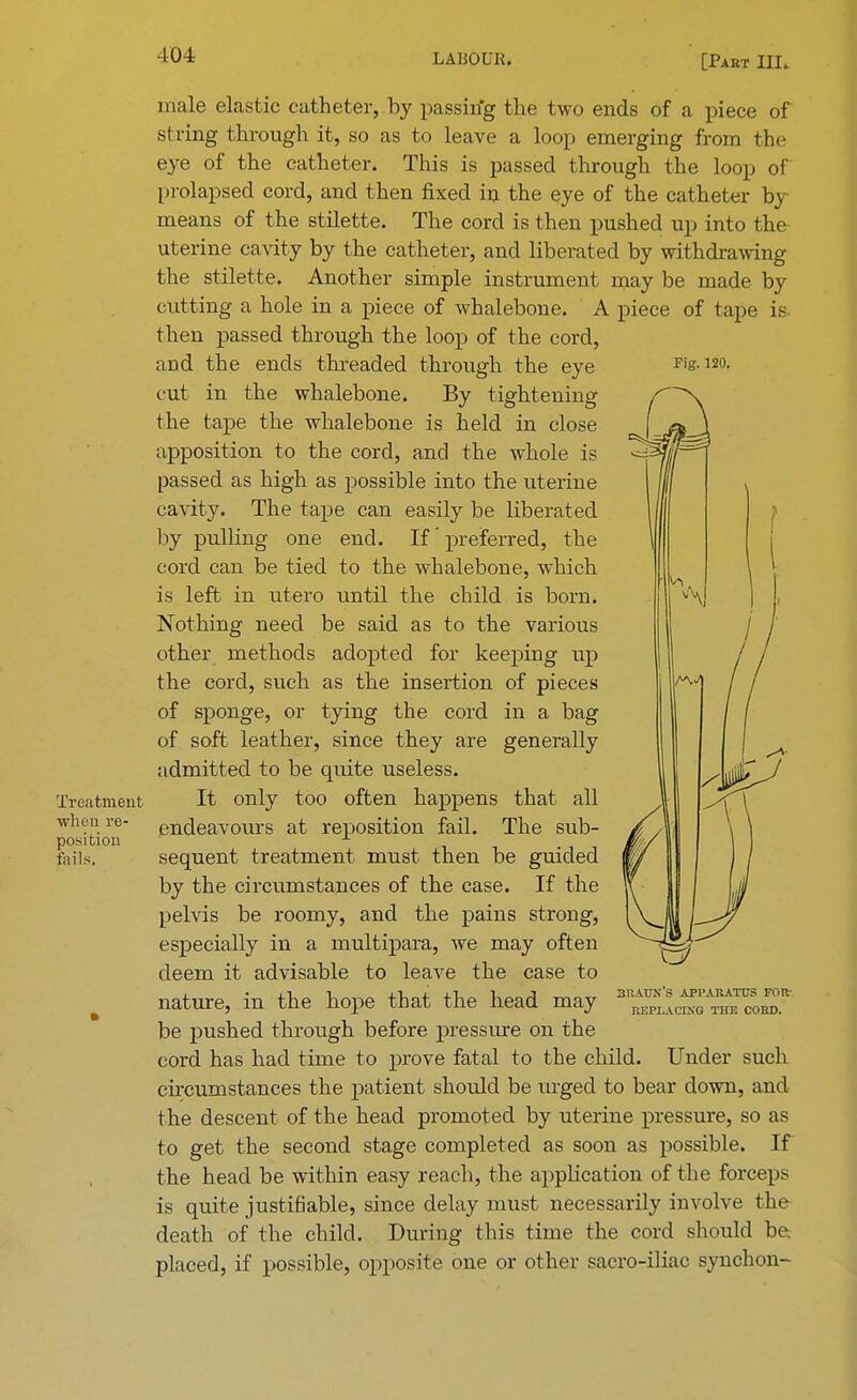 101 Treatment when re- position foils. Fig. 120. male elastic catheter, by passin'g the two ends of a piece of string through it, so as to leave a loop emerging from the eye of the catheter. This is passed through the loop of prolapsed cord, and then fixed in the eye of the catheter by means of the stilette. The cord is then pushed up into the uterine cavity by the catheter, and liberated by withdrawing the stilette. Another simple instrument may be made by cutting a hole in a piece of whalebone. A piece of tape is then passed through the loop of the cord, arid the ends threaded through the eye cut in the whalebone. By tightening the tape the whalebone is held in close apposition to the cord, and the whole is passed as high as possible into the uterine cavity. The tape can easily be liberated by pulling one end. If' preferred, the cord can be tied to the whalebone, which is left in utero until the child is born. Nothing need be said as to the various other methods adopted for keeping up the cord, such as the insertion of pieces of sponge, or tying the cord in a bag of soft leather, since they are generally ndmitted to be quite useless. It only too often happens that all endeavours at reposition fail. The sub- sequent treatment must then be guided by the circumstances of the case. If the pelvis be roomy, and the pains strong, especially in a multipara, we may often deem it advisable to leave the case to nature, in the hope that the head may be pushed through before pressure on the cord has had time to prove fatal to the child. Under such circumstances the patient should be urged to bear down, and the descent of the head promoted by uterine pressure, so as to get the second stage completed as soon as possible. If the head be within easy reach, the application of the forceps is quite justifiable, since delay must necessarily involve the death of the child. During this time the cord should be. placed, if possible, opposite one or other sacro-iliac synchon- 3I1AUNS APPARATUS FOR- REPLACING THE CORD.