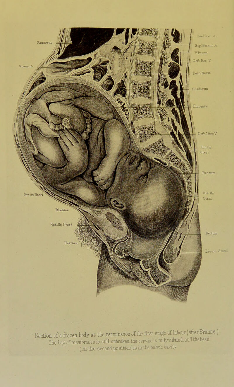 Section of afrozen body at the ternrmation of the first sta^e of laiour.(^erBraiiEe:) . Tiieki^;rfmeiiibraDesis stflIunbrolfea,theceFVDcisM7djliLted,anathehead (in the second position) is in the pelvic cavity: