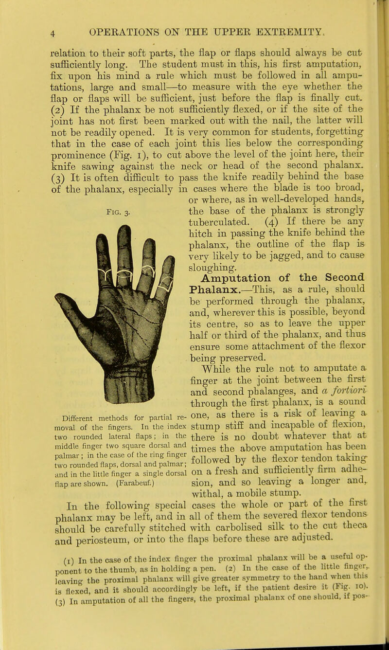 Fig. relation to their soft parts, the flap or flaps should always be cut sufficiently long. The student must in this, his first amputation, fix upon his mind a rule which must be followed in all ampu- tations, large and small—to measure with the eye whether the flap or flaps will be sufficient, just before the flap is finally cut. (2) If the phalanx be not sufficiently flexed, or if the site of the joint has not first been marked out with the nail, the latter will not be readily opened. It is very common for students, forgetting that in the case of each joint this lies below the corresponding prominence (Fig. 1), to cut above the level of the joint here, their knife sawing against the neck or head of the second phalanx. (3) It is often difficult to pass the knife readily behind the base of the phalanx, especially in cases where the blade is too broad, or where, as in well-developed hands, the base of the phalanx is strongly tuberculated. (4) If there be any hitch in passing the knife behind the phalanx, the outline of the flap is very likely to be jagged, and to cause sloughing. Amputation of the Second Phalanx.—This, as a rule, should be performed through the phalanx, and, wherever this is possible, beyond its centre, so as to leave the upper half or third of the phalanx, and thus ensure some attachment of the flexor being preserved. While the rule not to amputate a finger at the joint between the first and second phalanges, and a fortiori through the first phalanx, is a sound Different methods for partial re- 0U6, as there 18 a risk of leaving a. moval of the fingers, in the index stump stiff and incapable of flexion, two rounded lateral flaps; in the there is no doubt whatever that at middle finger two square dorsal and t^raeg foe aDOve amputation has been palmar; in the case of the ring finger h flexor tendon taking- two rounded flaps, dorsal and palmar; IU11U7U J v ~ . n „J1,Q and in the little finger a single dorsal on a fresh and sufficiently firm adhe- flap are shown. (Farabeuf.) sion, and so leaving a longer and,. withal, a mobile stump. In the following special cases the whole or part of the first phalanx may be left, and in all of them the severed flexor tendons should be carefully stitched with carbolised silk to the cut theca and periosteum, or into the flaps before these are adjusted. (1) In the case of the index finger the proximal phalanx will be a useful op- ponent to the thumb, as in holding a pen. (2) In the case of the little finger,, leaving the proximal phalanx will give greater symmetry to the hand when this is flexed, and it should accordingly be left, if the patient desire it (Fig. 10). (3) In amputation of all the fingers, the proximal phalanx of one should, if pos-