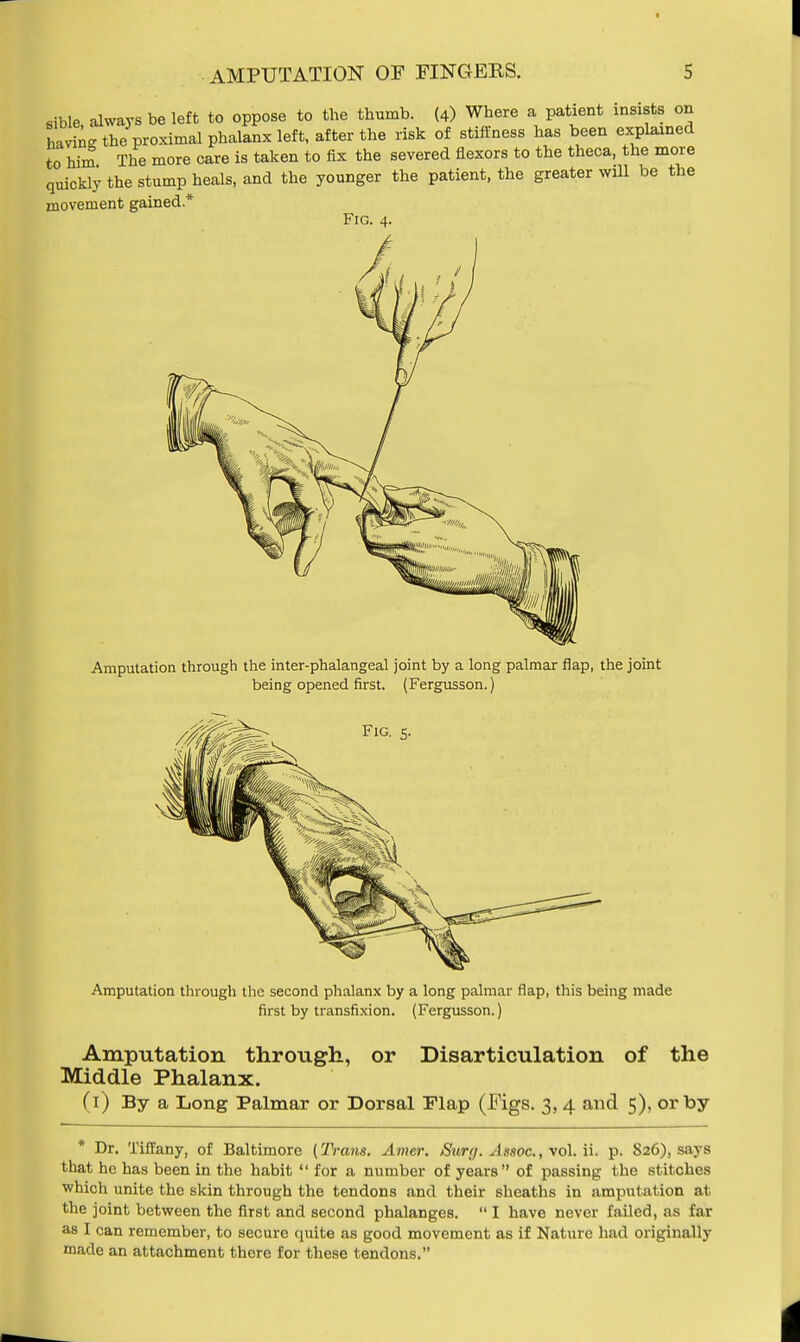 sible always be left to oppose to the thumb. (4) Where a patient insists on Invin-the proximal phalanx left, after the risk of stiffness has been explained to him The more care is taken to fix the severed flexors to the theca, the more quickly the stump heals, and the younger the patient, the greater will be the movement gained* Fig. 4. Amputation through the inter-phalangeal joint by a long palmar flap, the joint being opened first. (Fergusson.) Amputation through the second phalanx by a long palmar flap, this being made first by transfixion. (Fergusson.) Amputation through, or Disarticulation of the Middle Phalanx. (1) By a Long Palmar or Dorsal Flap (Figs. 3, 4 and 5), or by * Dr. Tiffany, of Baltimore (Trans. Amer. Surg. Assoc., vol. ii. p. 826), says that he has been in the habit  for a number of years of passing the stitches which unite the skin through the tendons and their sheaths in amputation at the joint between the first and second phalanges.  I have never failed, as far as I can remember, to secure quite as good movement as if Nature had originally made an attachment there for these tendons.