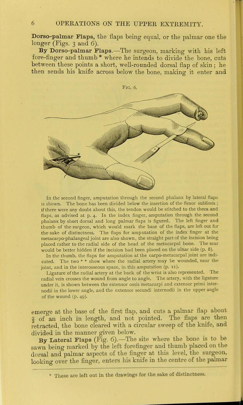 Dorso-palmar Maps, the flaps being equal, or the palmar one the longer (Figs. 3 and 6). By Dorso-palmar Flaps.—The surgeon, marking with his left fore-finger and thumb * where he intends to divide the bone, cuts between these points a short, well-rounded dorsal flap of skin; he then sends his knife across below the bone, making it enter and Fig. 6. In the second finger, amputation through the second phalanx by lateral flaps is shown. The bone has been divided below the insertion of the flexor sublimis ; if there were any doubt about this, the tendon would be stitched to the theca and flaps, as advised at p. 4. In the index finger, amputation through the second phalanx by short dorsal and long palmar flaps is figured. The left finger and thumb of the surgeon, which would mark the base of the flaps, are left out for the sake of distinctness. The flaps for amputation of the index finger at the metacarpo-phalangeal joint are also shown, the straight part of the incision being placed rather to the radial side of the head of the metacarpal bone. The scar would be better hidden if the incision had been placed on the ulnar side (p. 8). In the thumb, the flaps for amputation at the carpo-metacarpal joint are indi- cated. The two * * show where the radial artery may be wounded, near the joint, and in the interosseous space, in this amputation (p. 11). Ligature of the radial artery at the back of the wrist is also represented. The radial vein crosses the wound from angle to angle. The artery, with the ligature under it, is shown between the extensor ossis metacarpi and extensor primi inter- nodii in the lower angle, and the extensor secundi internodii in the upper angle of the wound (p. 49). emerge at the base of the first flap, and cuts a palmar flap about I of an inch in length, and not pointed. The flaps are then retracted, the bone cleared with a circular sweep of the knife, and divided in the manner given below. By Lateral Flaps (Fig. 6).—The site where the bone is to be sawn being marked by the left forefinger and thumb placed on the dorsal and palmar aspects of the finger at this level, the surgeon, looking over the finger, enters his knife in the centre of the palmar * These are left out in the drawings for the sake of distinctness.