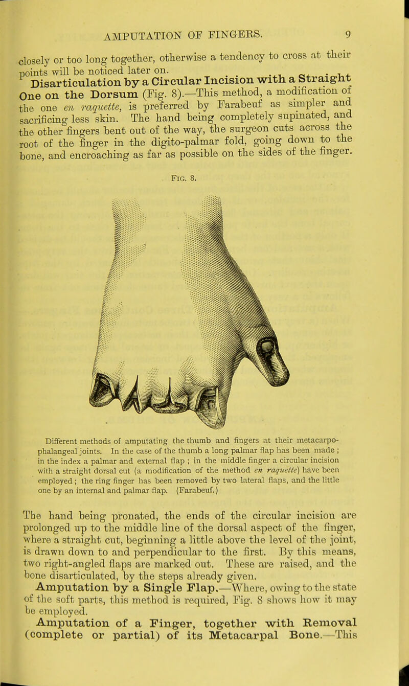 closely or too long together, otherwise a tendency to cross at their points will be noticed later on. , Disarticulation by a Circular Incision with a Straight One on the Dorsum (Fig. 8).—This method, a modification of the one en raquette, is preferred by Farabeuf as simpler and sacrificing less skin. The hand being completely supmated, and the other fingers bent out of the way, the surgeon cuts across the root of the finger in the digito-palmar fold, going down to the bone, and encroaching as far as possible on the sides of the finger. Fig. 8. Different methods of amputating the thumb and fingers at their metacarpo- phalangeal joints. In the case of the thumb a long palmar flap has been made ; in the index a palmar and external flap ; in the middle finger a circular incision with a straight dorsal cut (a modification of the method en raquette) have been employed ; the ring finger has been removed by two lateral flaps, and the little one by an internal and palmar flap. (Farabeuf.) The hand being pronated, the ends of the circular incisiou are prolonged up to the middle line of the dorsal aspect of the finger, where a straight cut, beginning a little above the level of the joint, is drawn down to and perpendicular to the first. By this means, two right-angled flaps are marked out. These are raised, and the bone disarticulated, by the steps already given. Amputation by a Single Flap.—Where, owing to the state of the soft parts, this method is required, Fig. 8 shows how it may be employed. Amputation of a Finger, together with Removal (complete or partial) of its Metacarpal Bone.—This