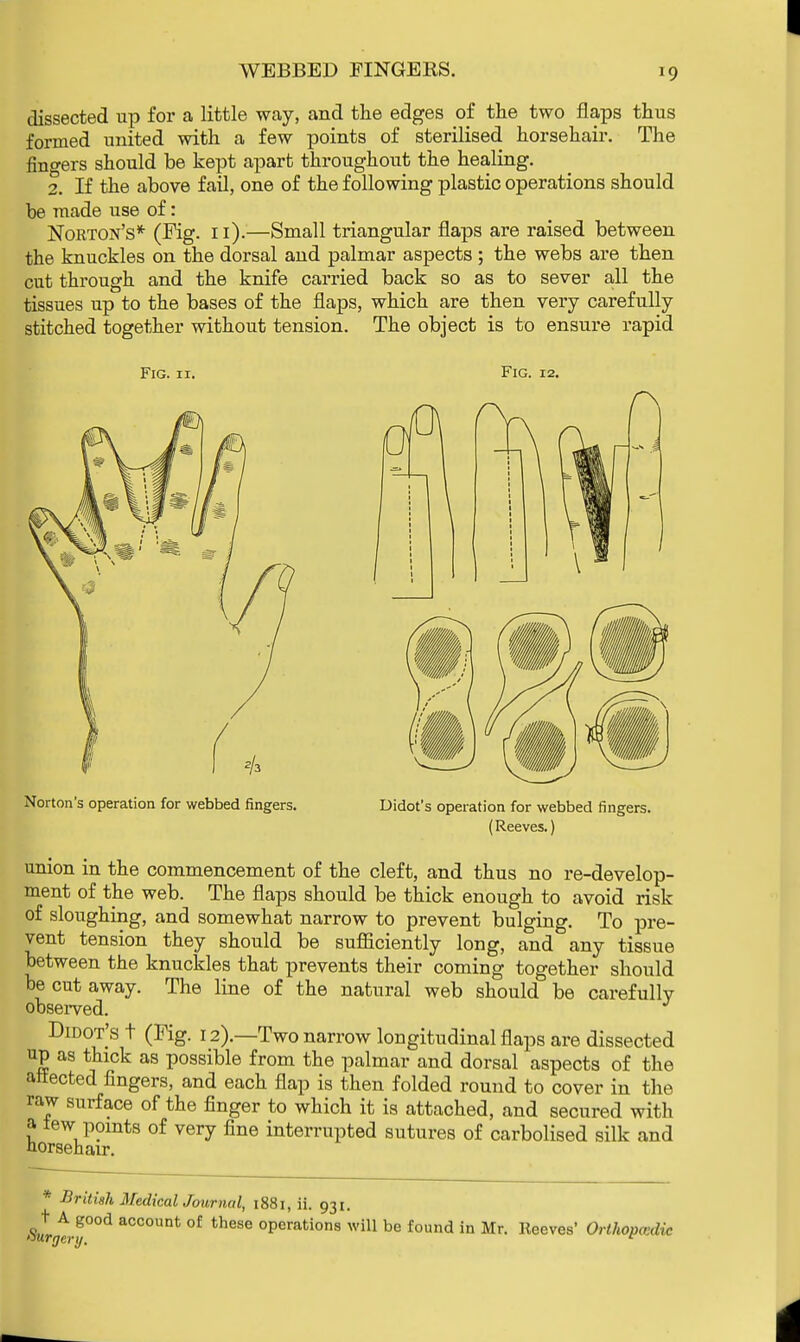 WEBBED FINGERS. dissected up for a little way, and the edges of the two flaps thus formed united with a few points of sterilised horsehair. The finders should be kept apart throughout the healing. 2. If the above fail, one of the following plastic operations should be made use of: Norton's* (Fig. 11).—Small triangular flaps are raised between the knuckles on the dorsal and palmar aspects ; the webs are then cut through and the knife carried back so as to sever all the tissues up to the bases of the flaps, which are then very carefully stitched together without tension. The object is to ensure rapid Fig. 11. Fig. 12. Norton's operation for webbed fingers. Didot's operation for webbed fingers. (Reeves.) union in the commencement of the cleft, and thus no re-develop- ment of the web. The flaps should be thick enough to avoid risk of sloughing, and somewhat narrow to prevent bulging. To pre- vent tension they should be sufficiently long, and any tissue between the knuckles that prevents their coming together should be cut away. The line of the natural web should be carefully observed. Didot's t (Fig. 12).—Two narrow longitudinal flaps are dissected up as thick as possible from the palmar and dorsal aspects of the aiiected fingers, and each flap is then folded round to cover in the raw surface of the finger to which it is attached, and secured with a tew points of very fine interrupted sutures of carbolised silk and horsehair. * British MedicalJournal, 1881, ii. 931. >%r^°°d aCC0UDt °f these °Perations will be found in Mr. Reeves' Orthopedic