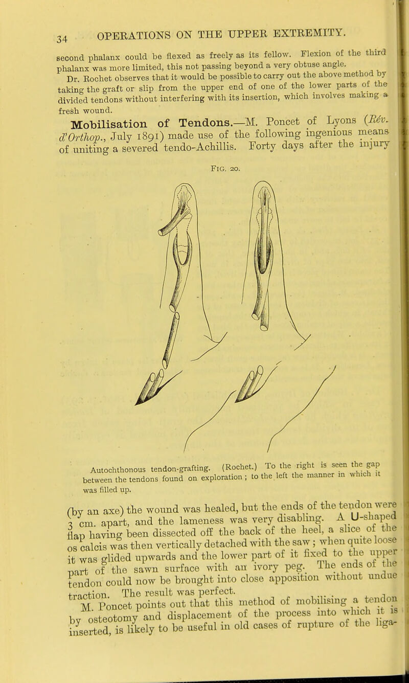 second phalanx could be flexed as freely as its fellow. Flexion of the third phalanx was more limited, this not passing beyond a very obtuse angle. Dr Rochet observes that it would be possible to carry out the above method by taking the graft or slip from the upper end of one of the lower parts of the divided tendons without interfering with its insertion, which involves making * fresh wound. Mobilisation of Tendons.—M. Poncet of Lyons (B4v. d'Orthop , July 1891) made use of the following ingenious means of uniting a severed tendo-Achillis. Forty days after the injury Fig. 20. Autochthonous tendon-grafting. (Rochet.) To the right is seen the gap between the tendons found on exploration; to the left the manner m which .t was filled up. (by an axe) the wound was healed, but the ends of the tendon were \ cm. apart, and the lameness was very disabling A U-shaped flan having been dissected off the back of the heel, a slice of the os calcis was then vertically detached with the saw; when quite loose it was glided upwards and the lower part of it fixed to the upper mrt of the sawn surface with an ivory peg. The ends of the tendon could now be brought into close apposition without undue traction. The result was perfect. • M Poncet points out that this method of mobilising a tendon hv osteotomy and displacement of the process into which it is hLrted isTkely to be useful in old cases of rupture of the hga.