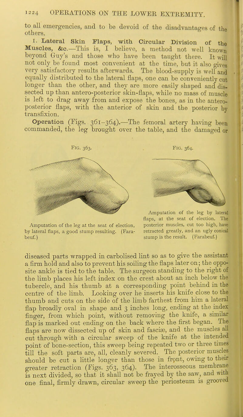 to all emergencies, and to be devoid of the disadvantages of the others. I. Lateral Skin Flaps, with Circular Division of the Muscles, &c.—This is, I believe, a method not well known beyond Guy's and those who have been taught there. It will not only be found most convenient at the time, but it also gives very satisfactory results afterwards. The blood-supply is well and equally distributed to the lateral flaps, one can be conveniently cut longer than the other, and they are more easily shaped and dis- sected up than antero-posterior skin-flaps, while no mass of muscle is left to drag away from and expose the bones, as in the antero- posterior flaps, with the anterior of skin and the posterior by transfixion. Operation (Figs. 361-364).—The femoral artery having been commanded, the leg brought over the table, and the damaged or Fig. 363. Fig. 364. flaps, at the seat of election. The Amputation of the leg at the seat of election, posterior muscles, cut too high, have by lateral flaps, a good stump resulting. (Fara- retracted greatly, and an ugly conical beuf.) stump is the result. (Farabeuf.) diseased parts wrapped in carbolised lint so as to give the assistant a firm hold and also to prevent his soiling the flaps later on; the oppo- site ankle is tied to the table. The surgeon standing to the right of the limb places his left index on the crest about an inch below the tubercle, and his thumb at a corresponding point behind in the centre of the limb. Looking over he inserts his knife close to the thumb and cuts on the side of the limb farthest from him a lateral flap broadly oval in shape and 3 inches long, ending at the hides: finger, from which point, without removing the knife, a similar flap is marked out ending on the back where the first began. The flaps are now dissected up of skin and fascite, and the muscles all cut through with a circular sweep of the knife at the intended point of bone-section, this sweep being repeated two or three times till the soft parts are, all, cleanly severed. The posterior muscles should be cut a little longer than those in front, owing to their greater retraction (Figs. 363, 364). The interosseous membrane is next divided, so that it shall not be frayed by the saw, and with one final, firmly drawn, circular sweep the periosteum is grooved