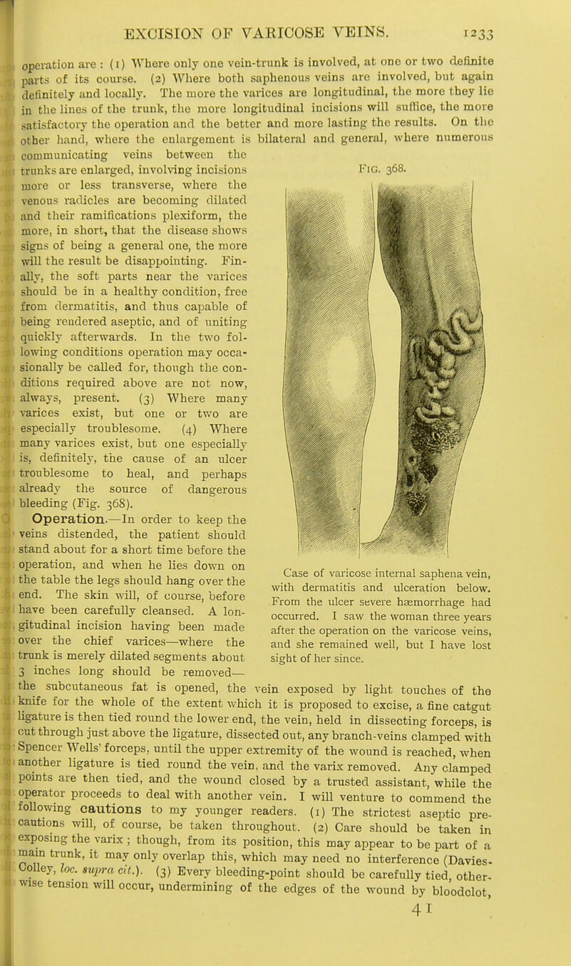 operation are : (1) Where only one vein-trunk is involved, at one or two definite parts of its course. (2) Where both saphenous veins are involved, but again definitely and locally. The more the varices are longitudinal, the more they lie in the lines of the trunk, the more longitudinal incisions will suffice, the more satisfactory the operation and the better and more lasting the results. On the other hand, where the enlargement is bilateral and general, where numerous communicating veins between the trunks are enlarged, involving incisions Fig. more or less transverse, where the venous radicles are becoming dilated and their ramifications plexiform, the more, in short, that the disease shows signs of being a general one, the more will the result be disappointing. Fin- ally, the soft parts near the varices should be in a healthy condition, free from dermatitis, and thus capable of being rendered aseptic, and of uniting quickly afterwards. In the two fol- lowing conditions operation may occa- sionally be called for, though the con- ditions required above are not now, always, present. (3) Where many varices exist, but one or two are especially troublesome. (4) Where many varices exist, but one especially is, definitely, the cause of an ulcer troublesome to heal, and perhaps already the source of dangerous bleeding (Fig. 368). Operation.—In order to keep the veins distended, the patient should stand about for a short time before the operation, and when he lies down on the table the legs should hang over the end. The skin will, of course, before have been carefully cleansed. A lon- gitudinal incision having been made over the chief varices—where the trunk is merely dilated segments about 3 inches long should be removed— the subcutaneous fat is opened, the vein exposed by light touches of the knife for the whole of the extent which it is proposed to excise, a fine catgut ligature is then tied round the lower end, the vein, held in dissecting forceps, is cut through just above the ligature, dissected out, any branch-veins clamped with Spencer Wells' forceps, until the upper extremity of the wound is reached, when another ligature is tied round the vein, and the varix removed. Any clamped points are then tied, and the wound closed by a trusted assistant, while the operator proceeds to deal with another vein. I will venture to commend the following cautions to my younger readers. (1) The strictest aseptic pre- cautions will, of course, be taken throughout. (2) Care should be taken exposing the varix ; though, from its position, this may appear to be part of main trunk, it may only overlap this, which may need no interference (Davies- Oolley, loc. supra cit.). (3) Every bleeding-point should be carefully tied other- wise tension will occur, undermining of the edges of the wound by bloodclot, 41 Case of varicose internal saphena vein, with dermatitis and ulceration below. From the ulcer severe hasmorrhage had occurred. I saw the woman three years after the operation on the varicose veins, and she remained well, but I have lost sight of her since. 111 a