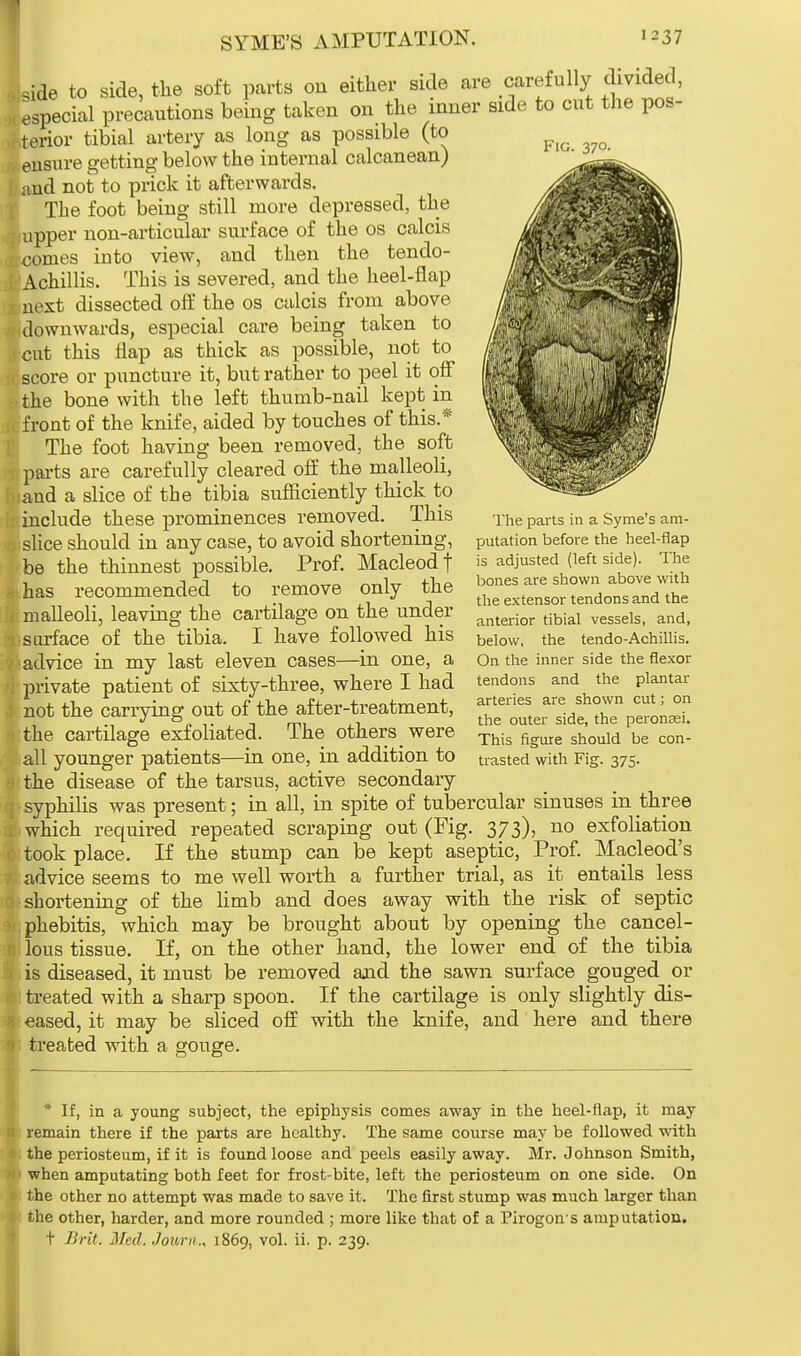 SYME'S AMPUTATION. •237 Fig. 370. side to side, the soft parts on either side are carefully divided, 1 especial precautions being taken on the inner side to cut the pos- terior tibial artery as long as possible (to '■ ensure getting below the internal calcanean) and not to prick it afterwards. The foot being still more depressed, the iirpper non-articular surface of the os calcis conies iuto view, and then the tendo- lAchillis. This is severed, and the heel-flap : next dissected off the os calcis from above [downwards, especial care being taken to cut this flap as thick as possible, not to score or puncture it, but rather to peel it off • the bone with the left thumb-nail kept in front of the knife, aided by touches of this.* The foot having been removed, the soft parts are carefully cleared off the malleoli, iand a slice of the tibia sufficiently thick to include these prominences removed. This slice should in any case, to avoid shortening, be the thinnest possible. Prof. Macleodf has recommended to remove only the malleoli, leaving the cartilage on the under surface of the tibia. I have followed his advice in my last eleven cases—in one, a private patient of sixty-three, where I had not the carrying out of the after-treatment, :the cartilage exfoliated. The others were all younger patients—in one, in addition to the disease of the tarsus, active secondary syphilis was present; in all, in spite of tubercular sinuses in three which required repeated scraping out (Fig. 373), no exfoliation took place. If the stump can be kept aseptic, Prof. Macleod's advice seems to me well worth a further trial, as it entails less shortening of the limb and does away with the risk of septic phebitis, which may be brought about by opening the cancel- lous tissue. If, on the other hand, the lower end of the tibia is diseased, it must be removed and the sawn surface gouged or treated with a sharp spoon. If the cartilage is only slightly dis- eased, it may be sliced off with the knife, and here and there treated with a gouge. The parts in a Syme's am- putation before the heel-flap is adjusted (left side). The bones are shown above with the extensor tendons and the anterior tibial vessels, and, below, the tendo-Achillis. On the inner side the flexor tendons and the plantar arteries are shown cut; on the outer side, the peronasi. This figure should be con- trasted with Fig. 375. * If, in a young subject, the epiphysis comes away in the beel-flap, it may remain there if the parts are healthy. The same course may be followed with the periosteum, if it is found loose and peels easily away. Mr. Johnson Smith, when amputating both feet for frost-bite, left the periosteum on one side. On the other no attempt was made to save it. The first stump was much larger than the other, harder, and more rounded ; more like that of a Pirogon s amputation. t Brit. Med. Journ., 1869, vol. ii. p. 239.