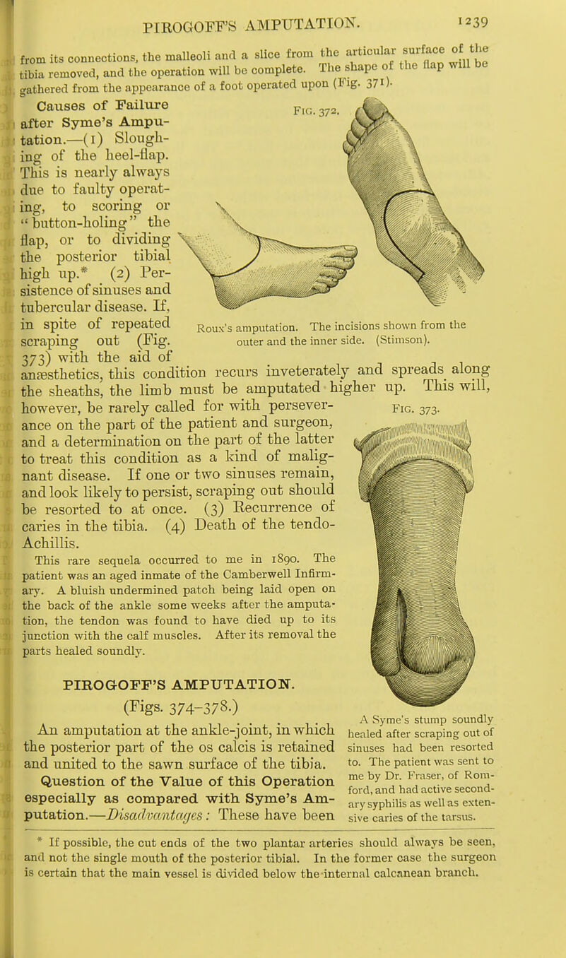 from its connections, the malleoli and a slice from the articular surface of the tibia removed, and the operation will be complete. The shape of the flap will be gathered from the appearance of a foot operated upon (Fig. 371). Causes of Failure Fig. 372. after Syme's Ampu- tation.—(i) Slough- ing of the heel-flap. This is nearly always due to faulty operat- ing, to scoring or button-holing the flap, or to dividing the posterior tibial high up.* (2) Per- sistence of sinuses and tubercular disease. If, in spite of repeated scraping out (Fig. 373) wvfcn *he °f anesthetics, this condition recurs inveterately and spreads along the sheaths, the limb must be amputated higher up. This will, Roux's amputation. The incisions shown from the outer and the inner side. (Stimson). however, be rarely called for with persever- ance on the part of the patient and surgeon, and a determination on the part of the latter to treat this condition as a kind of malig- nant disease. If one or two sinuses remain, and look likely to persist, scraping out should be resorted to at once. (3) Eecurrence of caries in the tibia. (4) Death of the tendo- Achillis. This rare sequela occurred to me in 1890. The patient was an aged inmate of the Camberwell Infirm- ary. A bluish undermined patch being laid open on the back of the ankle some weeks after the amputa- tion, the tendon was found to have died up to its junction with the calf muscles. After its removal the parts healed soundly. PIROGOFF'S AMPUTATION. (Figs. 374-378.) An amputation at the ankle-joint, in which the posterior part of the os calcis is retained and united to the sawn surface of the tibia. Question of the Value of this Operation especially as compared with Syme's Am- putation.—Disadvantages: These have been Fig. 373. A Syme's stump soundly- healed after scraping out of sinuses had been resorted to. The patient was sent to me by Dr. Fraser, of Rom- ford, and had active second- ary syphilis as well as exten- sive caries of the tarsus. * If possible, the cut ends of the two plantar arteries should always be seen, and not the single mouth of the posterior tibial. In the former case the surgeon is certain that the main vessel is divided below the internal calcnnean branch.