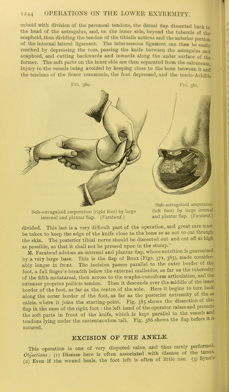 cuboid with division of the peroneal tendons, the dorsal ilap dissected back to the head of the astragalus, and, on the inner side, beyond the tubercle of the scaphoid, thus dividing the tendon of the tibialis anticus and the anterior portion of the internal lateral ligament. The interosseous ligament can then be easily reached by depressing the toes, passing the knife between the astragalus and scaphoid, and cutting backwards and inwards along the under surface of the former. The soft parts on the inner side are then separated from the calcaneum injury to the vessels being avoided by keeping close to the bone between it and the tendons of the flexor communis, the foot depressed, and the tendo-Achillis Fig. 380. Fig. 381. Sub-astragaloid amputation (right foot) by large internal and plantar flap. (Farabeuf.) Sub-astragaloid amputation (left foot) by large internal and plantar flap. (Farabeuf.) divided. This last is a very difficult part of the operation, and great care must be taken to keep the edge of the knife close to the bone so as not to cut through the skin. The posterior tibial nerve should be dissected out and cut off as high as possible, so that it shall not be pressed upon in the stump. M. Farabeuf advises an internal and plantar flap, whose nutrition is guaranteed by a very large base. This is the flap of Roux (Figs. 371, 385), made consider- ably longer in front. The incision passes parallel to the outer border of the foot, a full finger's-breadth below the external malleolus, as far as the tuberosity of the fifth metatarsal, then across to the scapho-cuneiform articulation, and the extensor proprius pollicis tendon. Then it descends over the middle of the inner border of the foot, as far as the centre of the sole. Here it begins to turn back along the outer border of the foot, as far as the posterior extremity of the os calcis, where it joins the starting-point. Fig. 385 shows the dissection of this flap in the case of the right foot: the left hand of the operator raises and protects the soft parts in front of the knife, which is kept parallel to the vessels and tendons lying under the sustentaculum tali. Fig. 3S6 shows the flap before it is sutured. EXCISION OF THE ANKLE. This operation is one of very disputed value, and thus rarely performed. Objections: (1) Disease here is often associated with disease of the tarsus. (2) Even if the wound heals, the foot left is often of little use. (3) Svme»