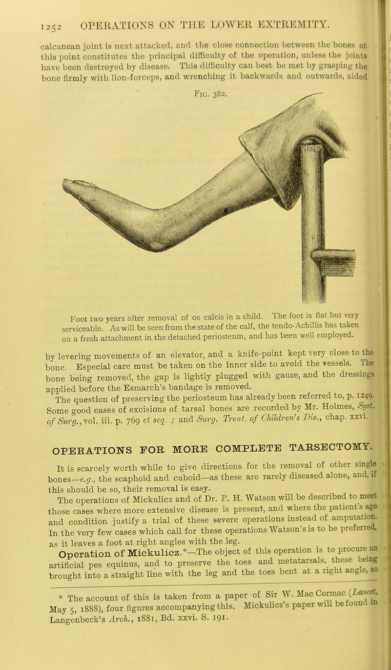 calcanean joint is next attacker], and the close connection between the bones at this point constitutes the principal difficulty of the operation, unless the joints have been destroyed by disease. This difficulty can best be met by grasping the bone firmly with lion-forceps, and wrenching it backwards and outwards, aided Fig. 382. — Foot two years after removal of os calcis in a child. The foot is flat but very serviceable. As will be seen from the state of the calf, the tendo-Achillis has taken on a fresh attachment in the detached periosteum, and has been well employed. by levering movements of an elevator, and a knife-point kept very close to the bone. Especial care must be taken on the inner side to avoid the vessels. The bone being removed, the gap is lightly plugged with gauze, and the dressings applied before the Esmarch's bandage is removed. The question of preserving the periosteum has already been referred to, p. 1249. Some good cases of excisions of tarsal bones are recorded by Mr. Holmes, Syst. of Surg., vol. ffi. p. 769 at seq. ; and Surg. Treat, of Children's Bis., chap. xxvi. OPEBATIONS FOR MORE COMPLETE TARSECTOMY. It is scarcely worth while to give directions for the removal of other single bones—e.g., the scaphoid and cuboid—as these are rarely diseased alone, and, if this should be so, their removal is easy. The operations of Mickulicz and of Dr. P. H. Watson will be described to meet those cases where more extensive disease is present, and where the patient s age and condition justify a trial of these severe operations instead of amputation. In the very few cases which call for these operations Watson's is to be preferred, as it leaves a foot at right angles with the leg. Operation of Mickulicz.*-The object of this operation is to procure an artificial pes equinus, and to preserve the toes and metatarsals, these being brought into a straight line with the leg and the toes bent at a right angle, so * The account of this is taken from a paper of Sir W. Mao Cormac (Z*y* May 5, 1888), four figures accompanying this. Mickulicz's paper will be found in Lange'nbeck's Arch., 1881, Bd. xxvi. S. 191.