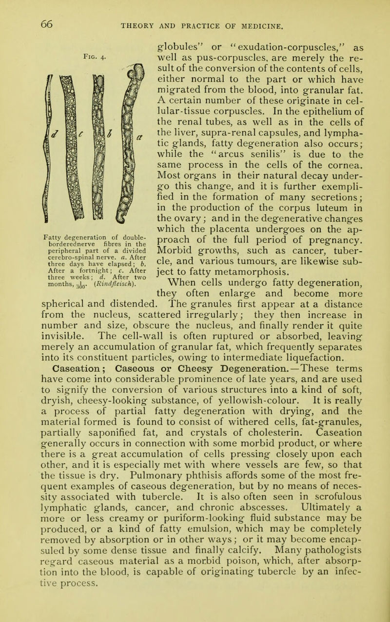 globules or exudation-corpuscles, as well as pus-corpuscles, are merely the re- sult of the conversion of the contents of cells, either normal to the part or which have migrated from the blood, into granular fat. A certain number of these originate in cel- lular-tissue corpuscles. In the epithelium of the renal tubes, as well as in the cells of the liver, supra-renal capsules, and lympha- tic glands, fatty degeneration also occurs; while the arcus senilis is due to the same process in the cells of the cornea. Most organs in their natural decay under- go this change, and it is further exempli- fied in the formation of many secretions; in the production of the corpus luteum in the ovary; and in the degenerative changes which the placenta undergoes on the ap- proach of the full period of pregnancy. Morbid growths, such as cancer, tuber- cle, and various tumours, are likewise sub- ject to fatty metamorphosis. When cells undergo fatty degeneration, they often enlarge and become more spherical and distended. The granules first appear at a distance from the nucleus, scattered irregularly; they then increase in number and size, obscure the nucleus, and finally render it quite invisible. The cell-wall is often ruptured or absorbed, leaving merely an accumulation of granular fat, which frequently separates into its constituent particles, owing to intermediate liquefaction. Caseation; Caseous or Cheesy Degeneration.—These terms have come into considerable prominence of late years, and are used to signify the conversion of various structures into a kind of soft, dryish, cheesy-looking substance, of yellowish-colour. It is really a process of partial fatty degeneration with drying, and the material formed is found to consist of withered cells, fat-granules, partially saponified fat, and crystals of cholesterin. Caseation generally occurs in connection with some morbid product, or where ihere is a great accumulation of cells pressing closely upon each other, and it is especially met with where vessels are few, so that the tissue is dry. Pulmonary phthisis affords some of the most fre- quent examples of caseous degeneration, but by no means of neces- sity associated with tubercle. It is also often seen in scrofulous lymphatic glands, cancer, and chronic abscesses. Ultimately a more or less creamy or puriform-looking fluid substance may be produced, or a kind of fatty emulsion, which may be completely removed by absorption or in other ways; or it may become encap- suled by some dense tissue and finally calcify. Many pathologists regard caseous material as a morbid poison, which, after absorp- tion into the blood, is capable of originating tubercle by an infec- tive process. Fig. 4. Fatty degeneration of double- borderednerve fibres in the peripheral part of a divided cerebro-spinal nerve, a. After three days have elapsed; b. After a fortnight; c. After three weeks; d. After two months, ^ (Rindfleisch).
