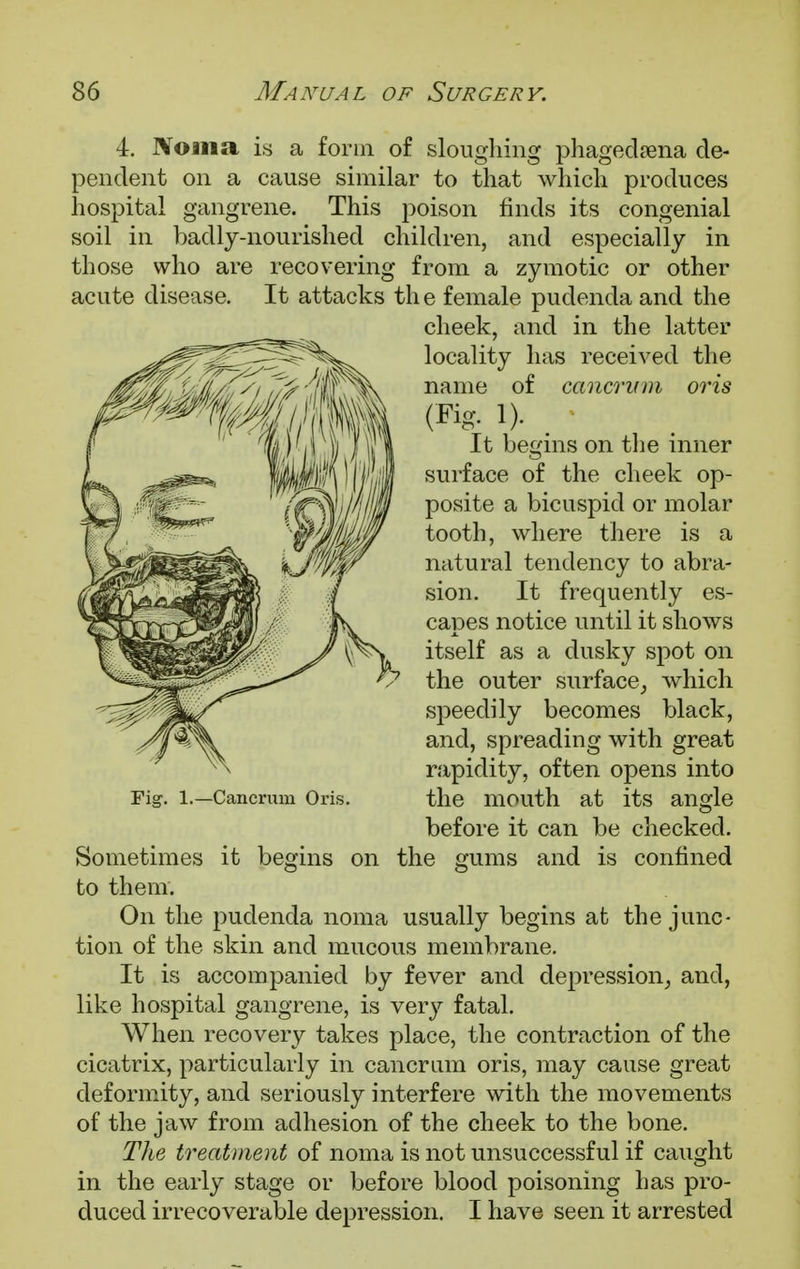4. Noma is a form of sloughing phagedena de- pendent on a cause similar to that which produces hospital gangrene. This poison finds its congenial soil in badly-nourished children, and especially in those who are recovering from a zymotic or other acute disease. It attacks th e female pudenda and the cheek, and in the latter locality has received the name of cancrvm oris (Fig. 1). • It begins on the inner surface of the cheek op- posite a bicuspid or molar tooth, where there is a natural tendency to abra- sion. It frequently es- capes notice until it shows itself as a dusky spot on the outer surface, which speedily becomes black, and, spreading with great rapidity, often opens into the mouth at its angle before it can be checked. Sometimes it begins on the gums and is confined to them. On the pudenda noma usually begins at the junc- tion of the skin and mucous membrane. It is accompanied by fever and depression, and, like hospital gangrene, is very fatal. When recovery takes place, the contraction of the cicatrix, particularly in cancrum oris, may cause great deformity, and seriously interfere with the movements of the jaw from adhesion of the cheek to the bone. The treatment of noma is not unsuccessful if caught in the early stage or before blood poisoning has pro- duced irrecoverable depression. I have seen it arrested