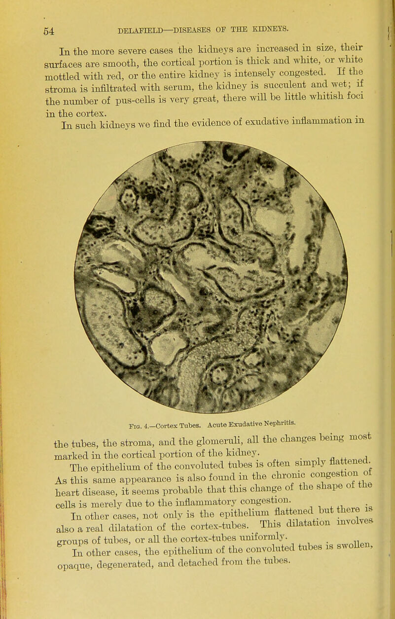 In the more severe cases the kidneys are increased in size, their surfaces are smooth, the cortical portion is thick and white, or white mottled with red, or the entire kidney is intensely congested. If the stroma is infiltrated with serum, the kidney is succulent and wet; if the number of pus-cells is very great, there will be little whitish foci in the cortex. . . a • In such kidneys we find the evidence of exudative inflammation in Fig. 4.—Cortex Tubes. Acute Exudative Nephritis. the tubes, the stroma, and the glomeruli, all the changes being most marked in the cortical portion of the kitbiey. i ^ The epithelium of the convoluted tubes is often simply flattened. As this same appearance is also found in the chronic conges ° heart disease, it seems probable that this change o e s ape cells is merely due to the inflammatory congestion. . In otta eases, not only is tte epiflieHnm feltenea tat there is also a real dilatation of the cortex-tubes. ^ This dilatation in groups of tubes, or all the cortex-tubes uuifoinilj. U other cas^s, the epitheUnm of the convoluted tubes is swoUen, opaque, degenerated, and detached from the tubes.