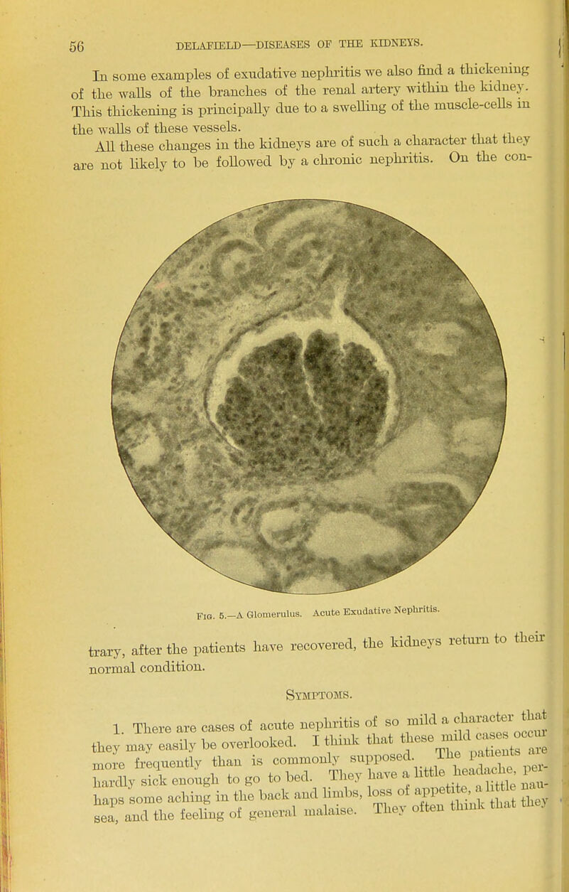 lu some examples of exudative neplu’itis we also find a tliickening of the walls of the branches of the renal aidery within the kidney. This thickening is principally due to a sweUing of the muscle-ceUs in the walls of these vessels. AU these changes in the kidneys are of such a character that they are not likely to be foUowed by a chronic nephiitis. On the con- FIG. 5.—A Glomerulus. Acute Exudative Nephritis. trary, after the patients have recovered, the kidneys return to then normal condition. Symptoms. 1. There are cases of acute nephritis of so mild a they may easily be overlooked. I think tha - n-iHents are more frequently than is commonly per- h.Pdly sick enough to go to bed. They have a ^ haps some aching in the back and limbs, loss o api sea, and the feeling of geueriil malaise. They