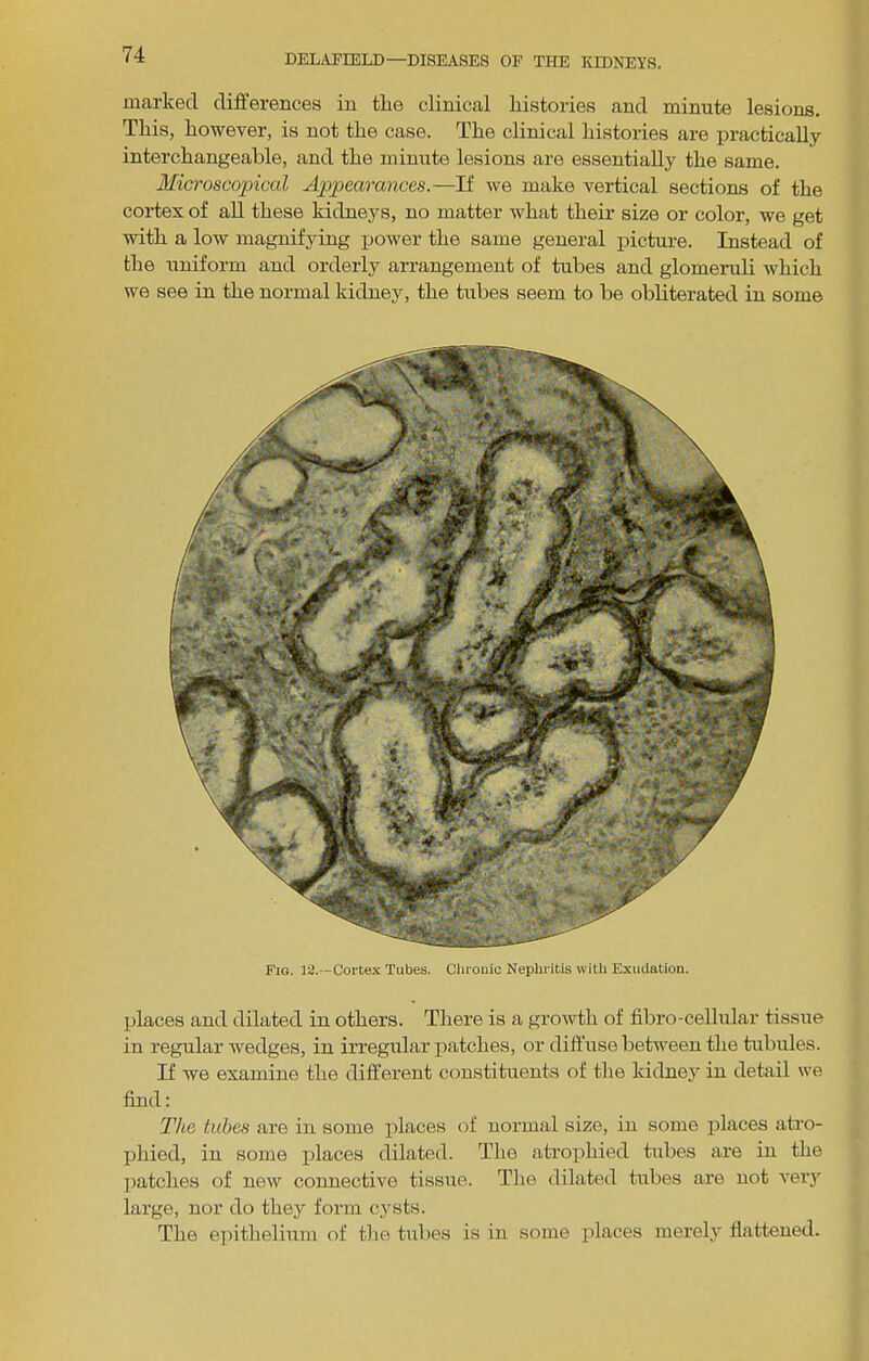 marked differences in tlie clinical histories and minute lesions. This, however, is not the case. The clinical histoi’ies are practically interchangeable, and the minute lesions are essentially the same. Microscopical Appearances.—If we make vertical sections of the cortex of aU these kidneys, no matter what their size or color, we get with a low magnifying jjower the same general y>icture. Instead of the uniform and orderly arrangement of tubes and glomeruli which we see in the normal kidney, the tubes seem to be obliterated in some Fig. 12.—Cortex Tubes. Cluouic Nephritis with Exudation. places and dilated in others. There is a growth of fibro-cellular tissue in regular wedges, in irregular jiatches, or diffuse betM'een the tubules. If we examine the different constituents of the kidney in detail we find: Tlie tubes are in some places of normal size, in some jilaces atro- phied, in some jilaces dilated. The atrophied tubes are in the patches of new connective tissue. The dilated tubes are not very large, nor do they form cysts. The eiiithelium of tlie tubes is in some places merely flattened.