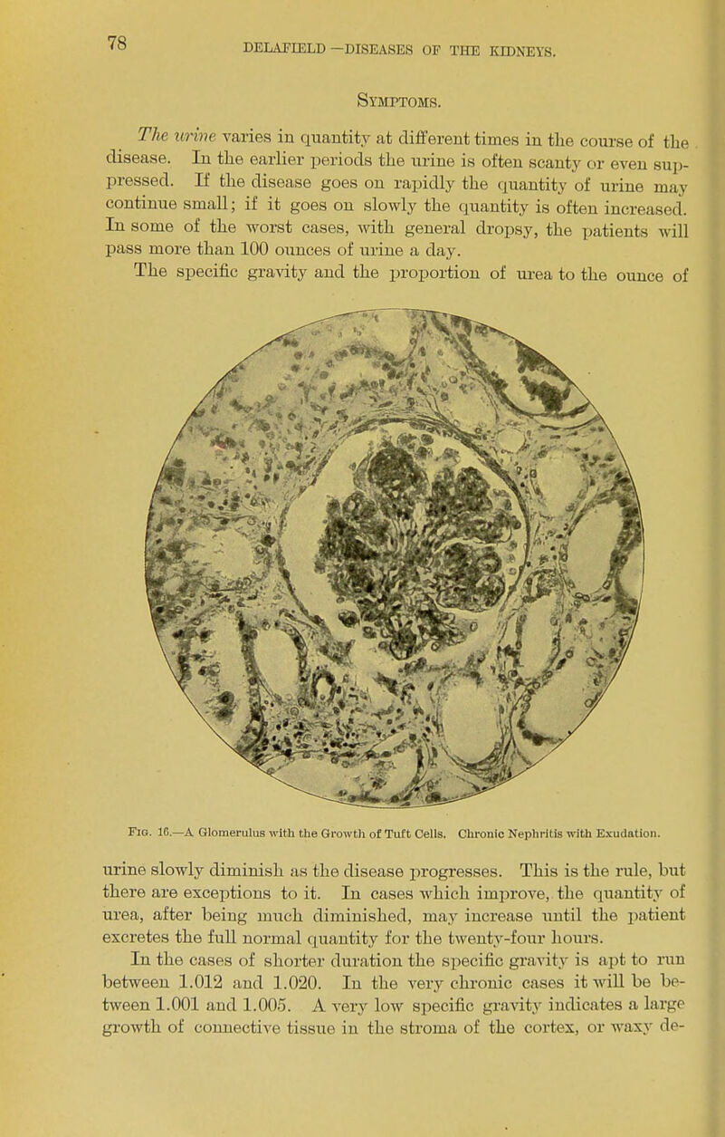 Symptoms. The urine varies in quantity at different time.s in the course of the disease. In the earlier periods the urine is often scanty or even sup- pressed. If the disease goes on rapidly the quantity of urine may continue small; if it goes on slowly the quantity is often inci’eased. In some of the worst cases, with general dropsy, the patients will pass more than 100 ounces of urine a day. The specific gravity and the proportion of urea to the ounce of Fig. 1G.—A Glomerulus with the Growth of Tuft Cells. Chronic Nephritis with Exudation. urine slowly diminish as the disease progresses. This is the rule, but there are exceptions to it. In cases Avhich improve, the quantity of urea, after being much diminished, may increase until the patient excretes the full normal quantity for the twenty-four hours. In the cases of shorter duration the specific gravity' is apt to run between 1.012 and 1.020. In the very chronic cases it will be be- tween 1.001 and 1.00.5. A very low specific gravity indicates a large growth of connective tissue in the stroma of the cortex, or waxy de-