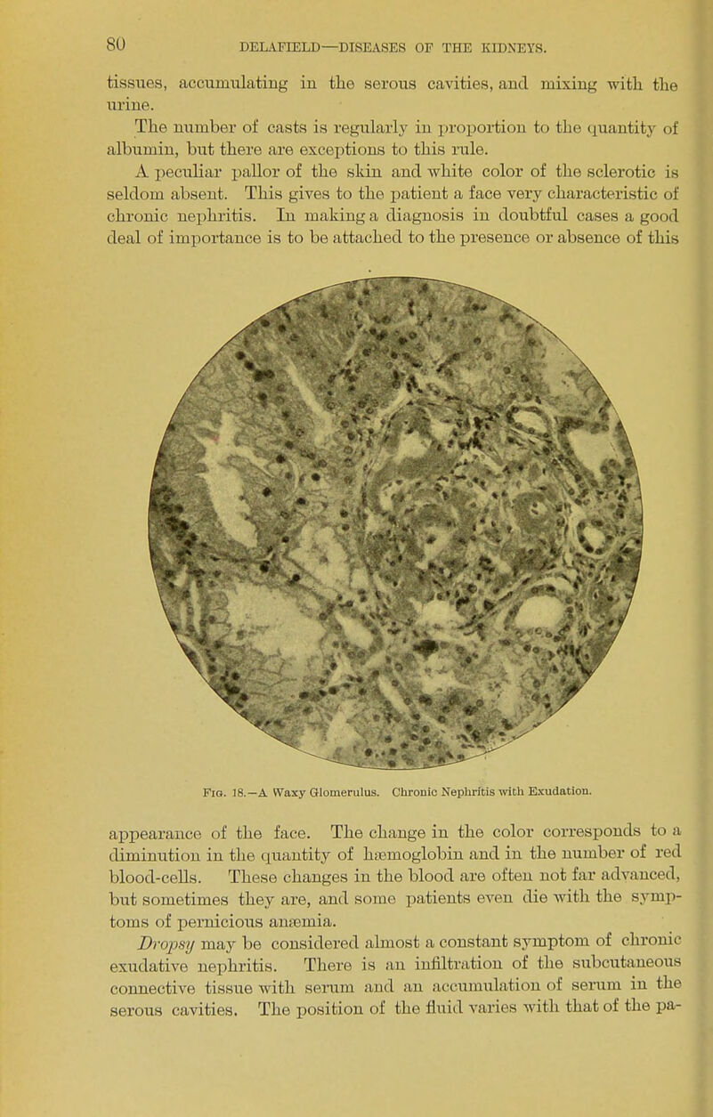 tissues, accumulating in tlie serous cavities, and mixing with the urine. The number of casts is regularlj in proportion to the ciuantity of albumin, but there are exceptions to this rule. A peculiar pallor of the shin and Avhite color of the sclerotic is seldom absent. This gives to the patient a face very characteristic of chronic nephritis. In making a diagnosis in doubtful cases a good deal of importance is to be attached to the f)resence or absence of this Fig. 18.—a Waxy Glomerulus. Chronic Nephritis with E.xudation. aj)pearance of the face. The change in the color corresponds to a diminution in the <xuantity of hmmoglobin and in the number of red blood-cells. These changes in the blood are often not far advanced, but sometimes they are, and some j^atients even die with the symp- toms of pernicious anasmia. Dropsy may be considered almost a constant symptom of chronic exudative nej)hritis. There is an infiltration of the subcutaneous connective tissue with semm and an accumulation of serum in the serous cavities. The jDosition of the fluid varies with that of the pa-