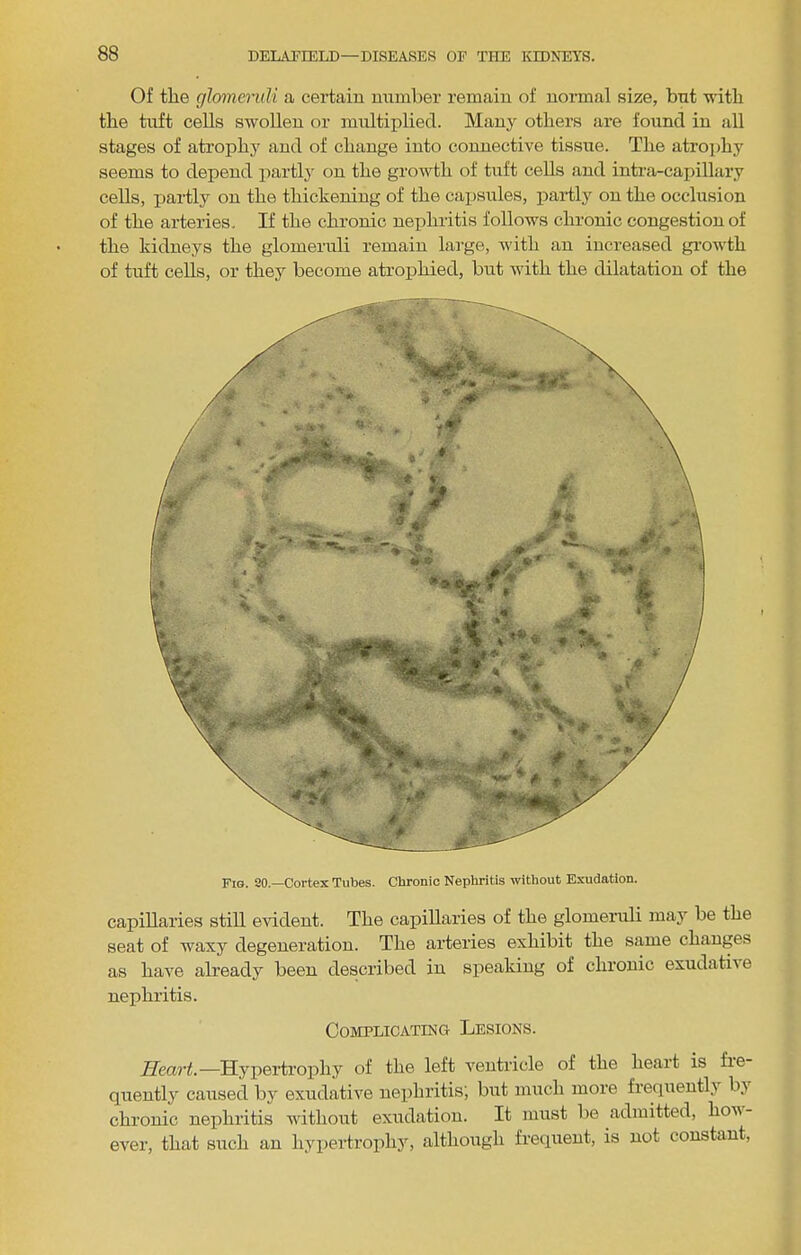 Of the glomeruli a certain number remain of noi-mal size, but with the tuft cells swollen or multiplied. Many others are found in all stages of atrophy and of change into connective tissue. The atrophy seems to depend partly on the growth of tuft cells and inti’a-capillary cells, pai-tly on the thickening of the capsules, partly on the occlusion of the arteries. If the chronic nephritis follows chronic congestion of the kidneys the glomeruli remain lai-ge, Avith an increased growth of tuft cells, or they become atrophied, but with the dilatation of the Fio. SO.—Cortex Tubes. Chronic Nephritis without Exudation. capillaries still eAudent. The capillaries of the glomeruli may be the seat of waxy degeneration. The aideries exhibit the same changes as haA^e already been described in speaking of chronic exudatiAe nephritis. Complicating Lesions. Heart.—Hypertroiohy of the left ventricle of the heart is fie- quently caused by exudative nephritis; but much more fi'eqtiently by chronic nephritis Avithout exudation. It must be admitted, hoAA- ever, that such an hypertrophy, although frequent, is not constant.