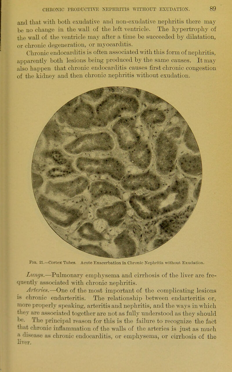 and that with both exudative aud uou-exudative nephritis there may be no change in the wall of the left ventricle. The hypertrophy of the wall of the A-entricle may after a time be succeeded by dilatation, or chronic degeneration, or myocarditis. Chronic endocarditis is often associated with this form of nephritis, apparently both lesions being produced by the same causes. It may also hajApen that chronic endocarditis causes first chronic congestion of the kidney and then chronic nephritis without exudation. Fio. 21.—Cortex Tubes. Acute Exacerbation in Chronic Nephritis without Exudation. LirnffH.—Pulmonary emphysema and cirrhosis of the liver are fre- quently associated Avith chronic nejihritis. Artf'nes.—One of the most important of the complicating lesions IS chronic endarteritis. The relationshii) betAV'^een endarteritis or, more projierly sjieaking, arteritis and nephritis, and the Avays in Avhich they are associated tfigetlier are not as fully understood as they should bf;. The i)riucij>al reason for this is the failure to recognize the fact that chronic inflammation of the Avails of the arteries is just as much a disease as chronic endocarditis, or emphysema, or cirrhosis of the liver.